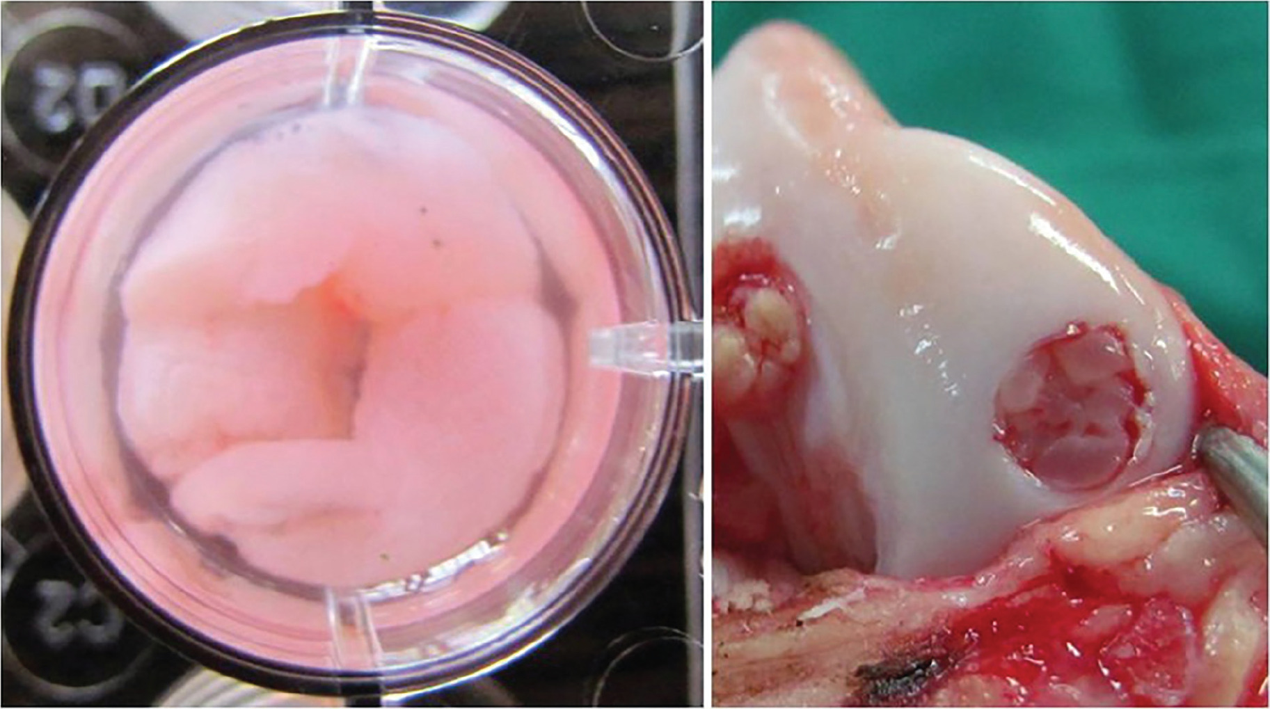 Fig. 1 
            Platelet-rich fibrin (PRF) seeded with stem cells. Bone marrow derived mesenchymal stem cells were seeded onto PRF in the laboratory and incubated for 6 hours (left) before being press fitted inside the cartilage defects (right).
          