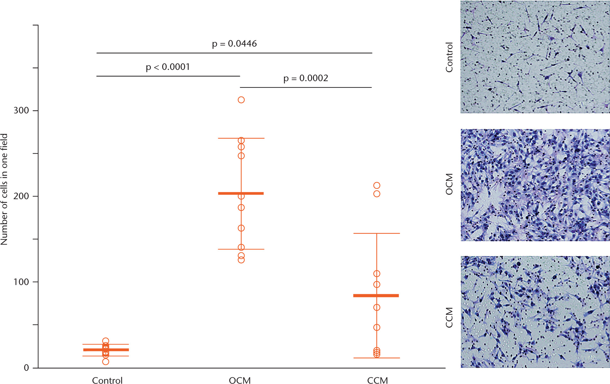Fig. 7 
            Migration assay using Transwell chambers, showing a significantly higher migration activity of MG-63 cells towards osteophyte-conditioned medium than towards cancellous bone-conditioned medium and the untreated control after six hours of incubation. The cells were counted in three randomly selected microscopic fields (×400) and the mean taken, with representative images shown for the ten experiments (original magnification, ×400). The results are reported as mean and standard deviation. Statistical analysis was performed using one-way analysis of variance with Tukey’s post hoc test (all n = 10). OCM, osteophyte-conditioned medium; CCM, cancellous bone-conditioned medium.
          