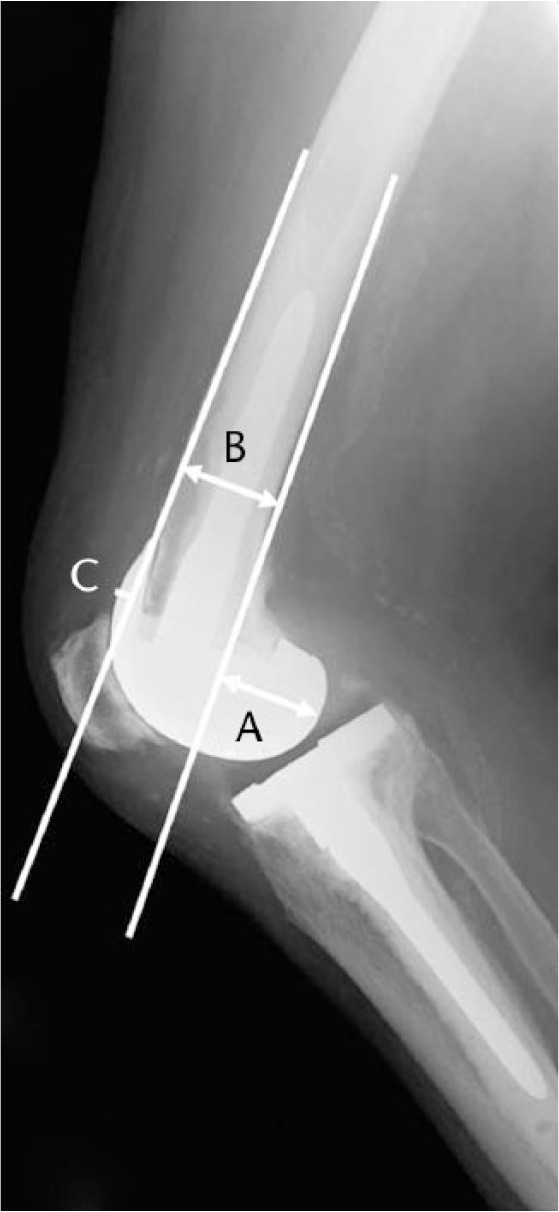 Fig. 2 
            Measurement of posterior condylar offset (PCO) and anterior condylar offset (ACO) on a true lateral radiograph to the distal femur. PCO was measured (A) relative to the tangent of the posterior cortex of the femur and ACO was measured (C) relative to the tangent of the anterior cortex of the femur. The PCO ratio was calculated by dividing PCO by the width of the femoral diaphysis at the level of the condylar flare (A/B). The ACO ratio was calculated by dividing ACO by the width of the femoral diaphysis at the level of the condylar flare (C/B).
          