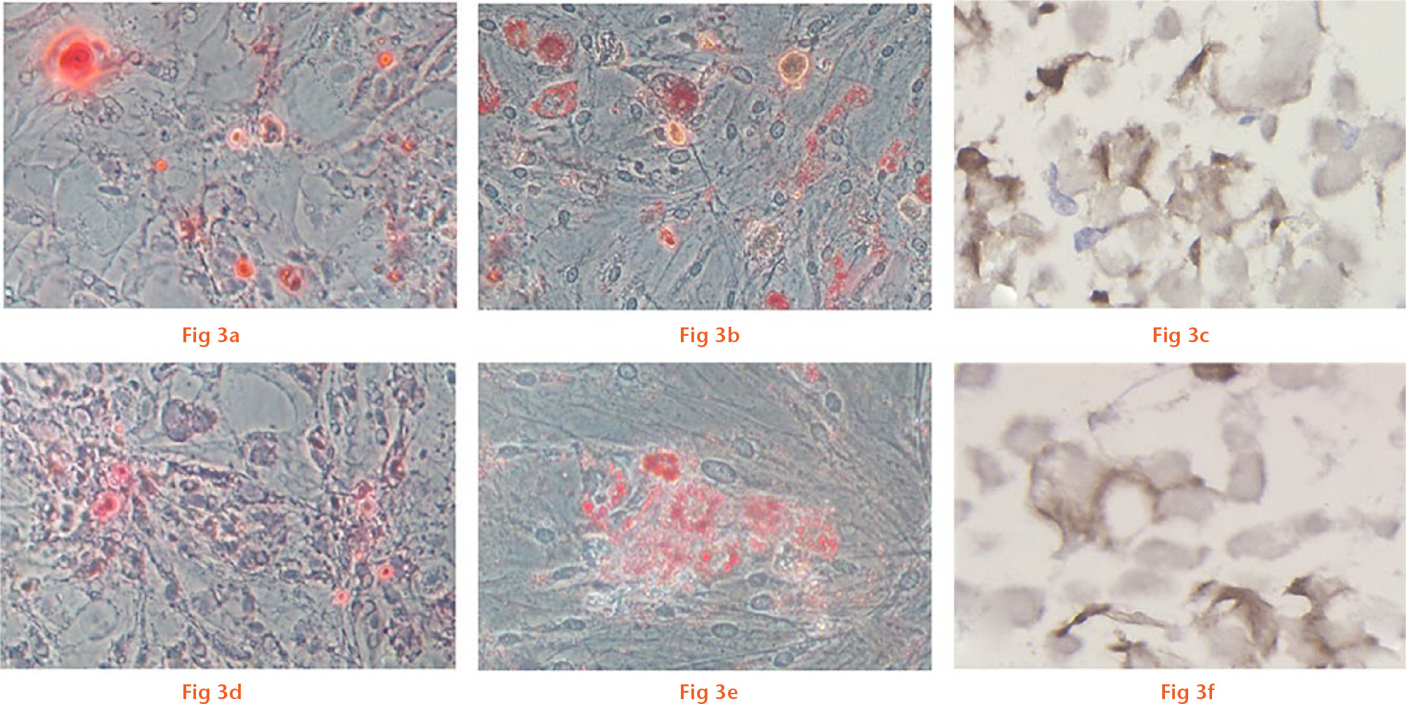  
            Multilineage differentiation potential of P3 cells that proliferated in normal medium (a to c) and P4 cells that proliferated in medium with low-dose G-CSF (d to f). Osteogenesis is detected by the deposition of calcium mineralisation using alizarin red staining (a, d, ×200). Adipogenesis is indicated by the accumulation of lipid vacuoles using oil red O staining (b, e, ×200). Chondrogenesis is indicated by the cartilage-specific matrix using collagen type II staining (c, f, ×400).
          