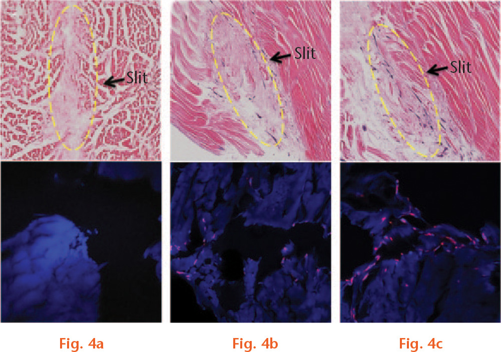  
            Histological findings of longitudinal sections of tendon scaffolds in H&E staining (top) and 6-diamidino-2-phenylindole (DAPI) (DAPI) cell tracker staining (bottom) demonstrated that no cells were seen in the decellularised tendons a). Seeded cells were present in the bone marrow stromal cell-seeded tendons with H&E staining and DAPI cell tracker staining (bottom) b). In the cell-seeded tendon with cyclic loading group, the viable cells were also observed inside the tendon with cell migration into tendon substance under both H&E (top) and DAPI cell tracking (bottom) images c).
          