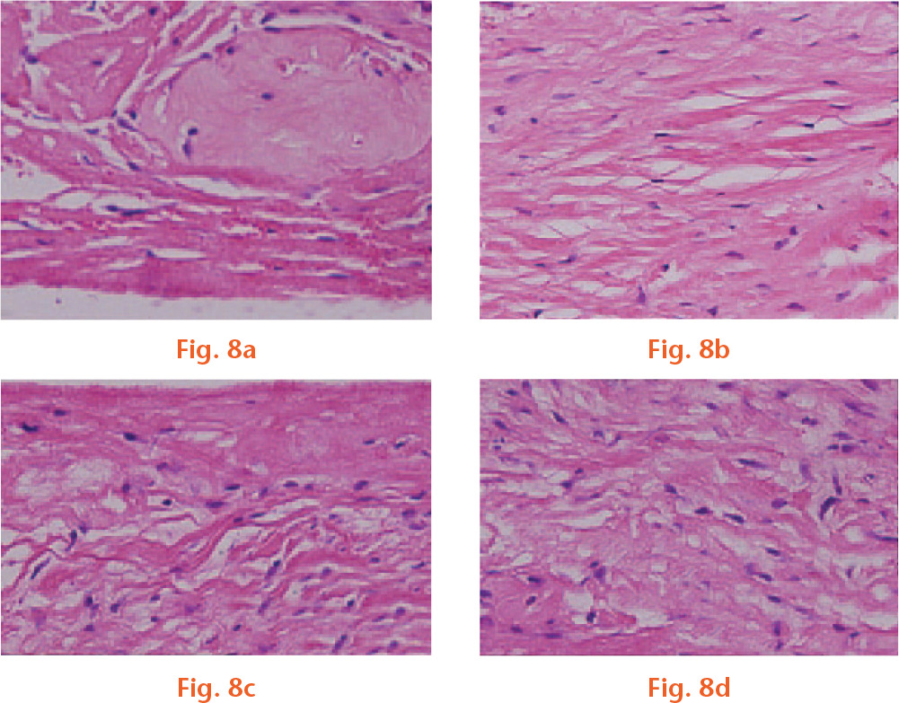  
            At 24 weeks post-implantation, the defects in the c) CBA and d) auto groups were repaired by newly generated hyaline cartilage shown by the formation of lacunae and cell clusters. The new-formed cartilage integrated well with its adjacent cartilage, although the interface between engineered and normal cartilage could still be identified. However, there were few cells and lacunae in the control group a). The BA group b) showed better results in terms of healing ability compared with the control group, but worse than those in the CBA group, haematoxylin and eosin ×200.
          