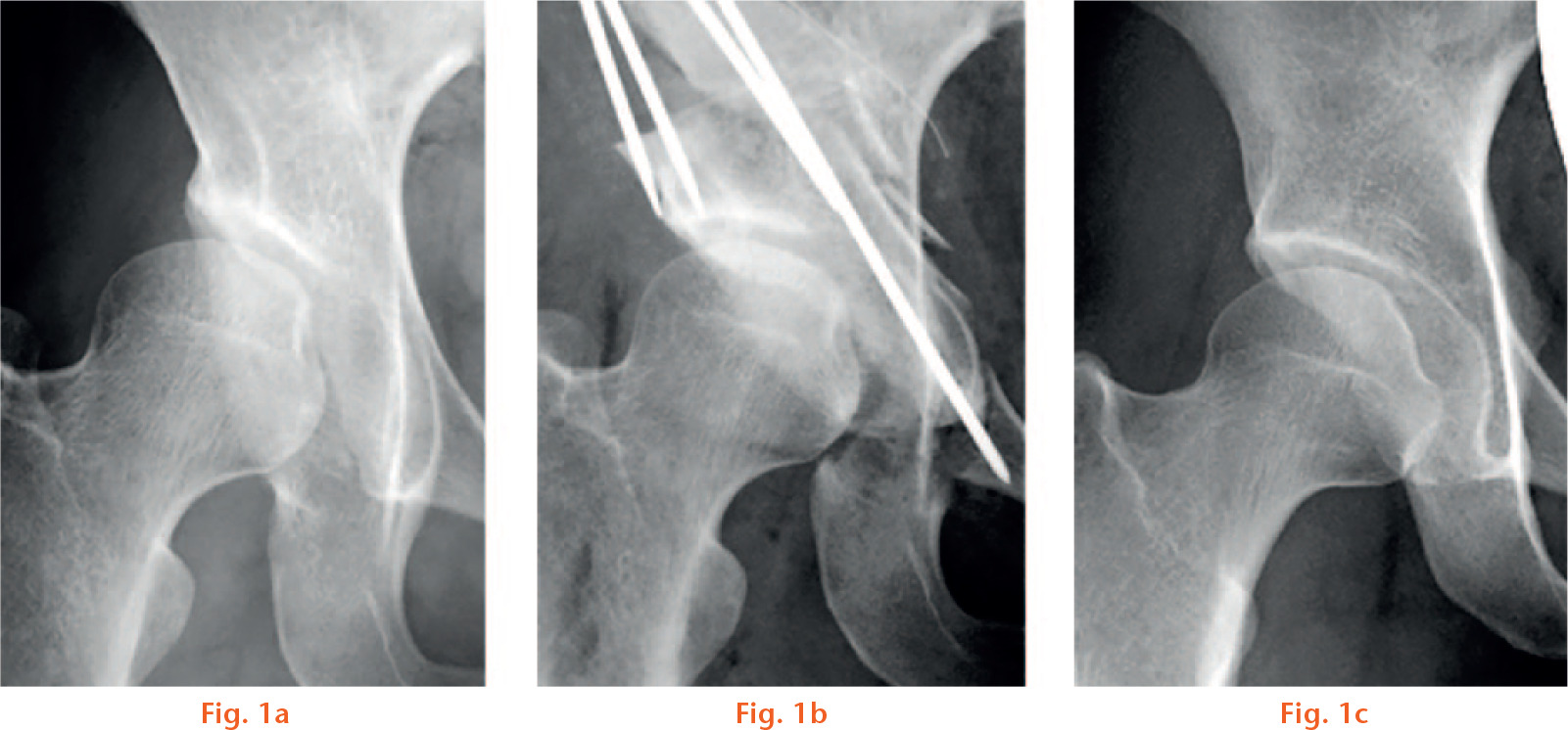  
            Anteroposterior radiographs of acetabular dysplasia (AD) pre- and post-operatively, and a control hip: a) case 61: AD hip of a 42-year-old female; Sharp angle 56.3°; centre-edge (CE) angle 3.5°; acetabular roof obliquity (ARO) angle 29.6°; minimum joint space width (MJSW) 3.7 mm; developmental dyaplasia of the hip, positive; b) case 61: post-periacetabular osteotomy; c) control 26: normal hip of a 30-year-old female; Sharp angle 38.6°; CE angle 28.8°; ARO angle 9.9°; MJSW 3.3 mm.
          