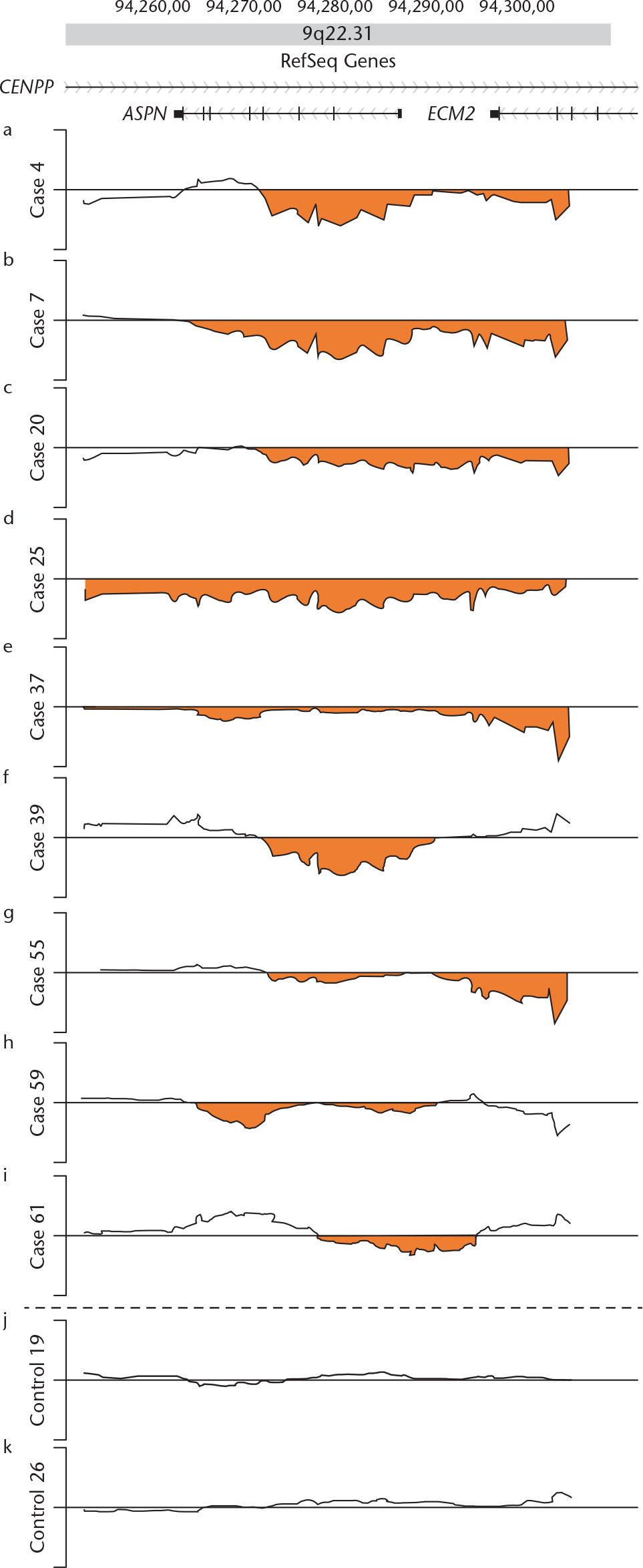 Fig. 2 
            Fine structures of the loss of copy number in the 60 kb 9q22.31 region harbouring the ASPN gene resolved by Agilent high-density tiling microarray. Log2 ratio (y-axis) was plotted using the moving mean along the genome position (x-axis). Plots for the nine affected acetabular dysplasia patients (cases 4, 7, 20, 25, 37, 39, 55, 59, and 61) are shown in parallel with plots of two control subjects (controls 19 and 26). The dark line represents a copy number plot along the genome for each subject between genomic positions 94 250 000 (left) and 94 310 000 (right). The orange areas indicate ‘‘loss of copy number”. The top map shows the positions of putative genes in the region.35CENPP, centromere protein p; ASPN, asporin; ECM2, extracellular matrix protein 2.
          