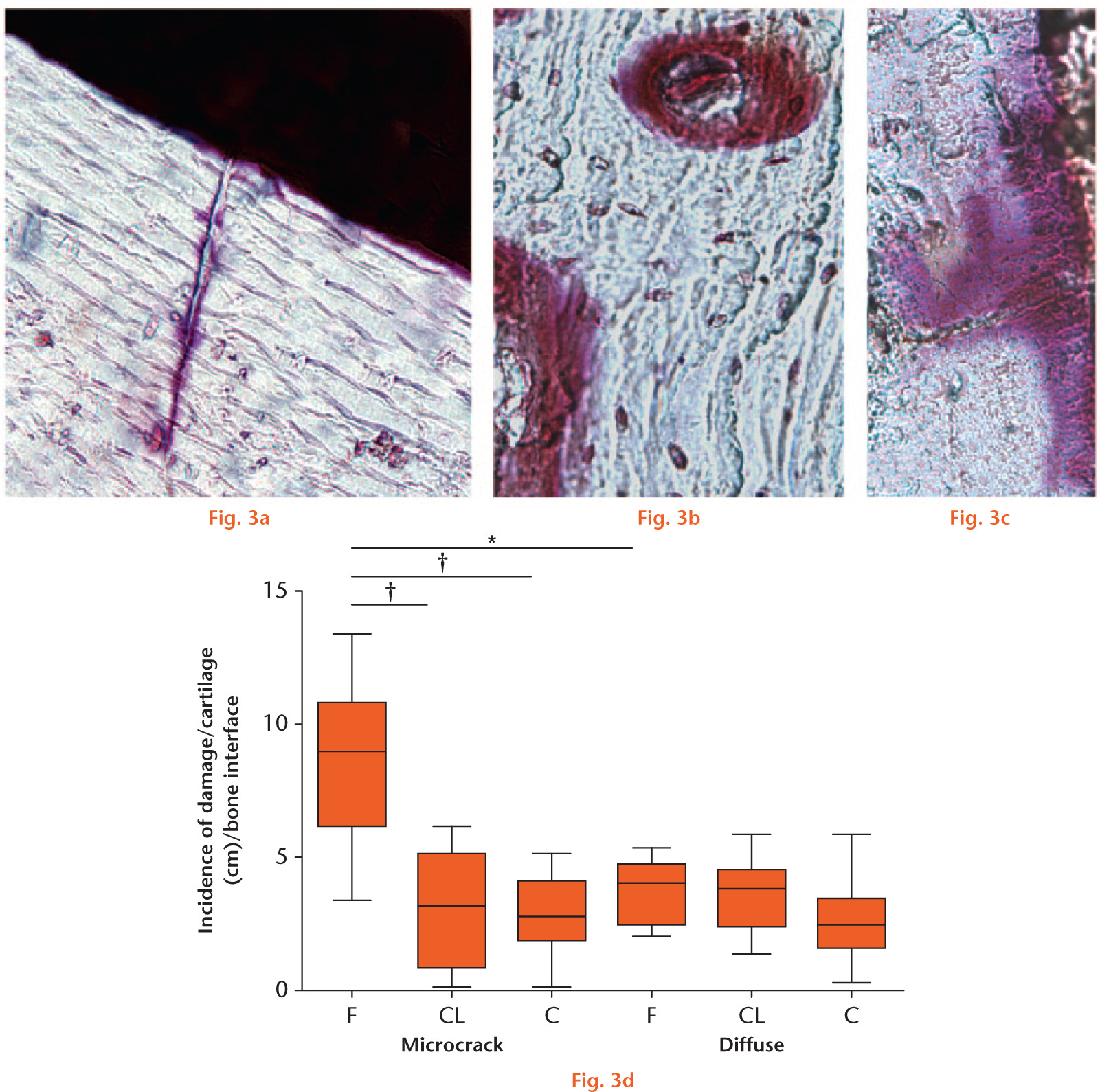  
            Representative micrographs of acid fuchsin-labelled structures in metacarpal bones: a) linear microcrack extending from articular surface; b) staining around blood vessels; and c) diffuse microdamage extending from articular surface. d) Graph showing the amount of damage per surface area of section for microcracks and diffuse damage. There was no difference in the amount of diffuse damage quantified in the three groups; however, there was a statistically significant difference between the amount of microcrack damage/surface area in the lateral condyle (site D, Figure 2) compared with both contralateral and control bones. Scale bar 100 μm. F, fractured bones; Cl, contralateral bones; C, control bones. *p ≤ 0.5; †p ≤ 0.005.
          