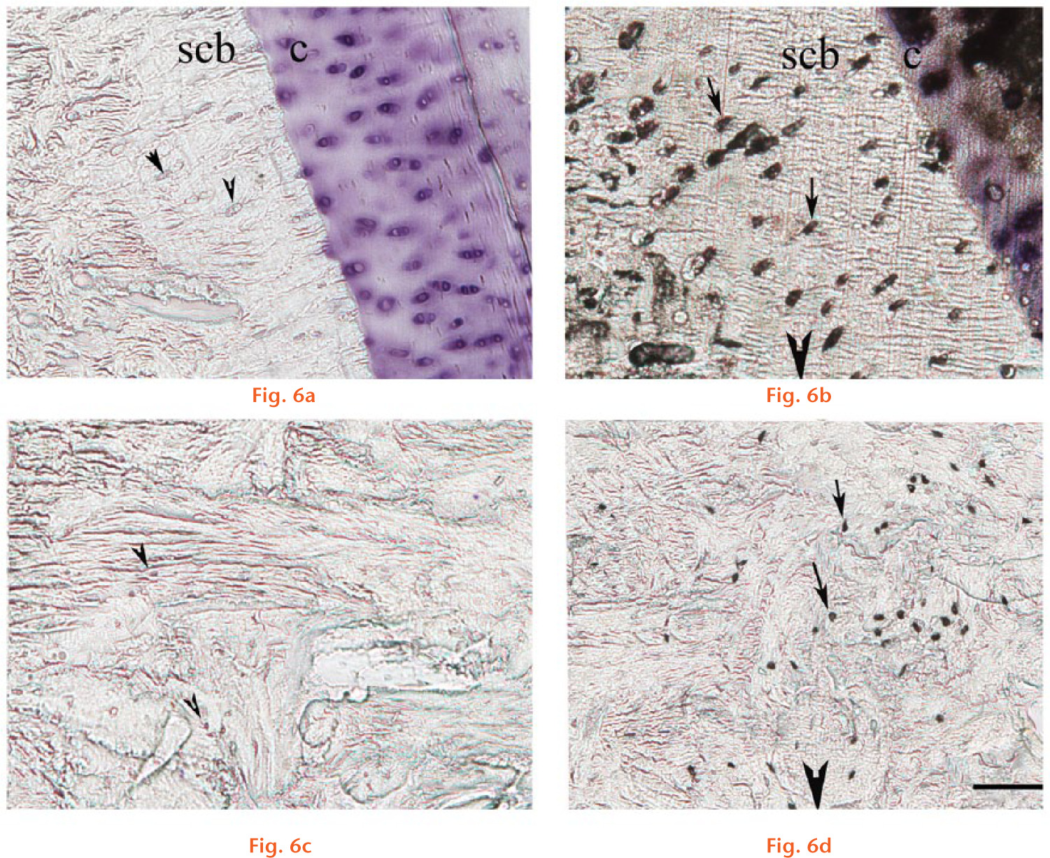  
            Representative photomicrographs of sclerostin immunohistochemistry: a) subchondral bone area control sample; b) subchondral area fracture sample; c) deep zone control sample; and d) deep zone fracture sample. Osteocytes – arrowheads in a) and c) – stained positively for sclerostin are seen as black cells in b) and d) (Group F) and are shown by black arrows. In a), the cartilage is stained with toluidine blue. Scale bar 100 μm. c, cartilage; scb, subchondral bone. The cartilage is stained with toluidine blue and is visible in a) and b). The fracture site is to the bottom of the figures in b) and d) (black arrowhead).
          