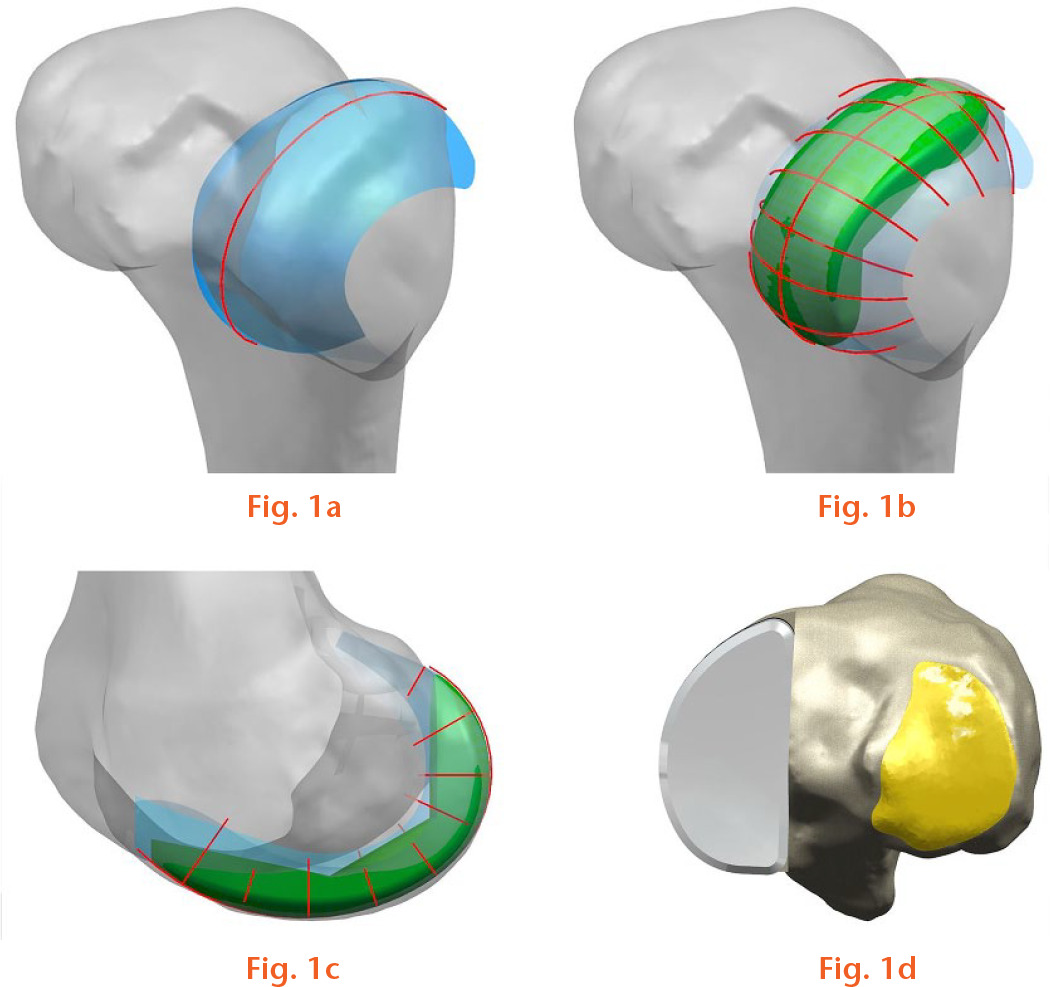  
            Design process of patient-specific unicompartmental knee arthroplasty for the a) subject's anatomic ‘J’ curve; b) spline curves used to model the femoral component; c) femoral component; and d) polyethylene insert that provides an anatomical fit and a perfect coverage.
          