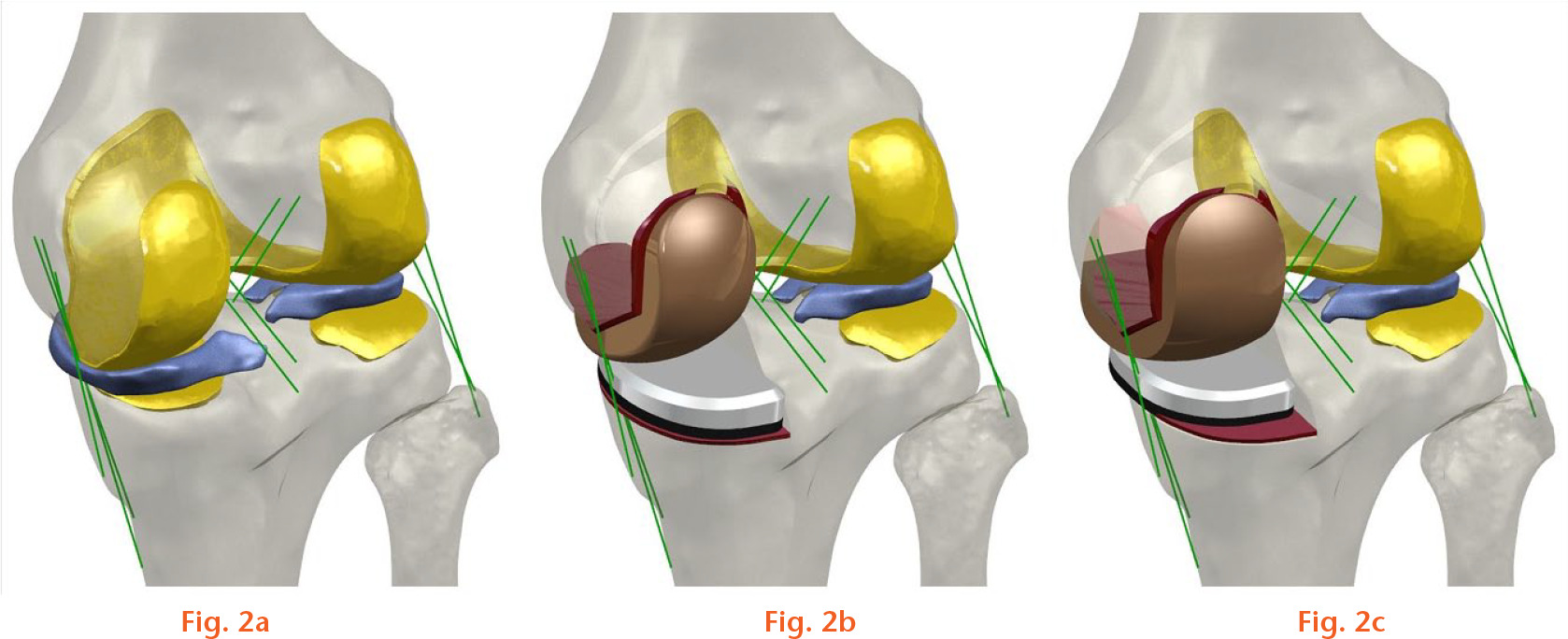  
            Finite element models used in the analysis: (a) normal knee; (b) patient-specific unicompartmental knee arthroplasty (UKA); and (c) standard UKA.
          