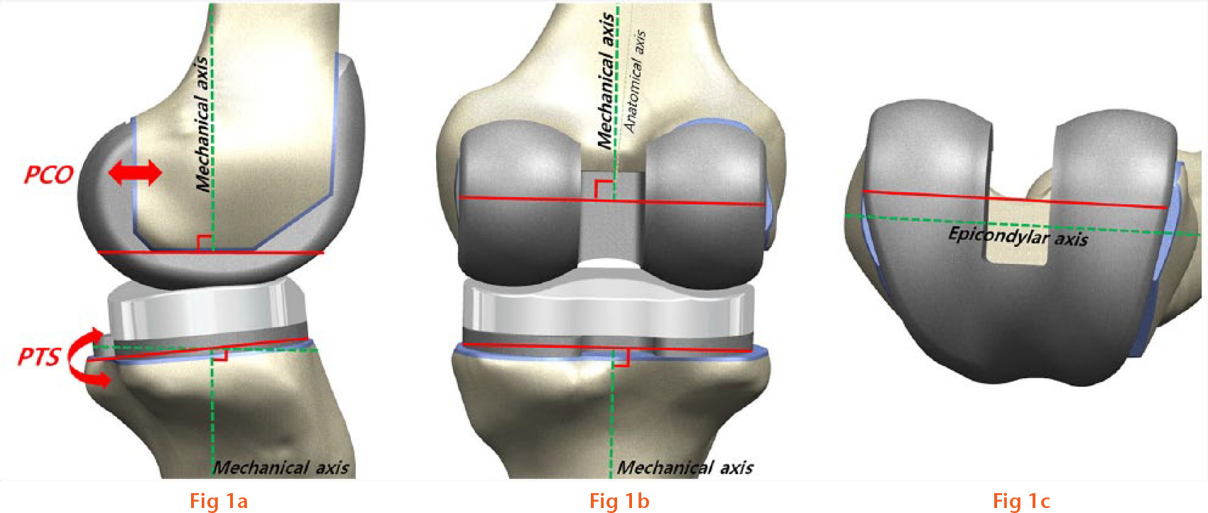  
            Diagram showing the orientation of the total knee arthroplasty used in this study in the a) sagittal plane, b) coronal plane and c) transverse plane (PCO, posterior condylar offset; PTS, posterior tibial slope).
          