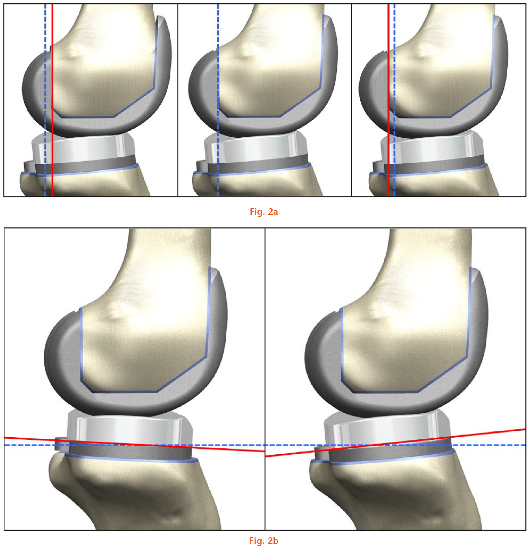  
            Schematic of the knee models with respect to change in a) posterior condylar offset (left) at anterior 3 mm (- 3 mm), (middle) 0 mm and (right) posterior 3 mm (+ 3 mm), and b) posterior tibial slope at - 3° and + 6°.
          