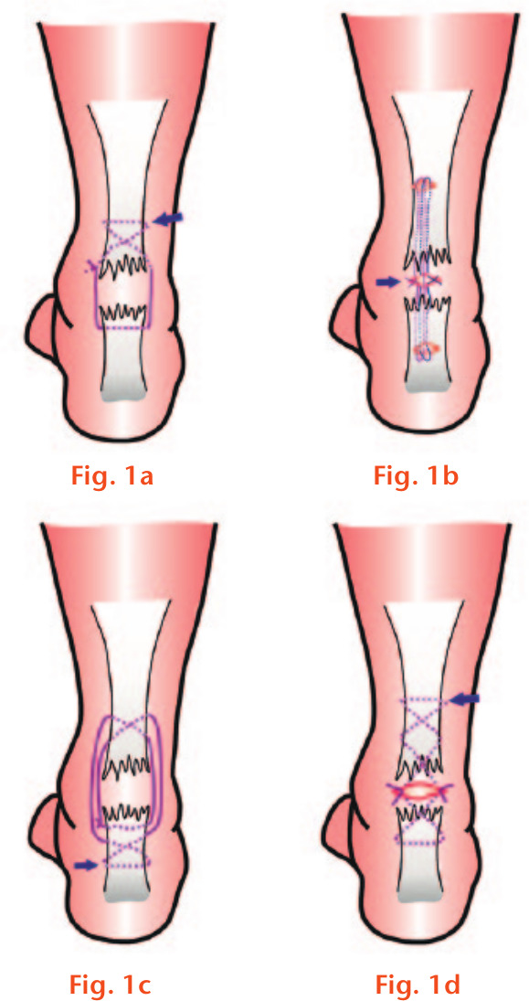  
            Schematic diagram of several minimally invasive suture methods: a) Ma–Griffith repair configuration; b) Webb–Bannister repair configuration; c) Cretnik’s repair configuration; and d) Carmont’s repair configuration.
          