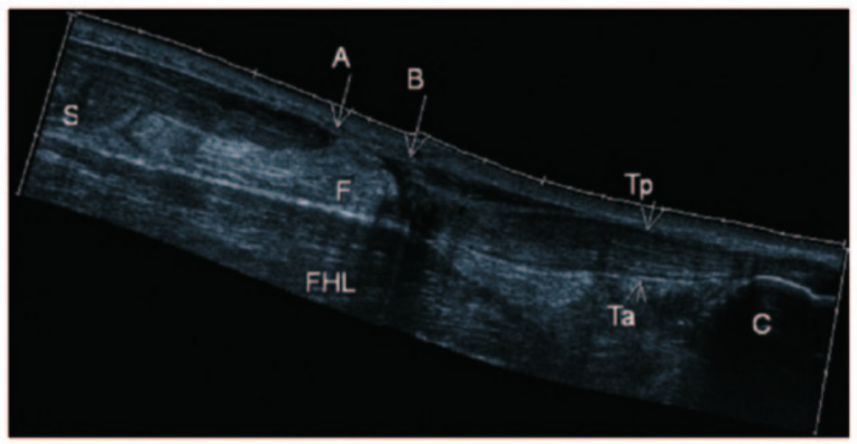 Fig. 2 
          Ultrasonography. Measurements were performed by identifying the tendon ends on the central part of the tendon on a sagittal scan. The mean of three separate measurements was used as the result value of the gap. A-B, gap of tendon rupture; C, calcaneus; F, fat tissue; FHL, flexor hallucis longus muscle; S, soleus muscle; Ta, anterior tendon surface; Tp, posterior tendon surface. Reproduced from Westin O, Nilsson Helander K, Gravare Silbernagel K et al. Acute ultrasonography investigation to predict reruptures and outcomes in patients with an Achilles tendon rupture. Orthop J Sports Med 2016;4:2325967116667920.
        