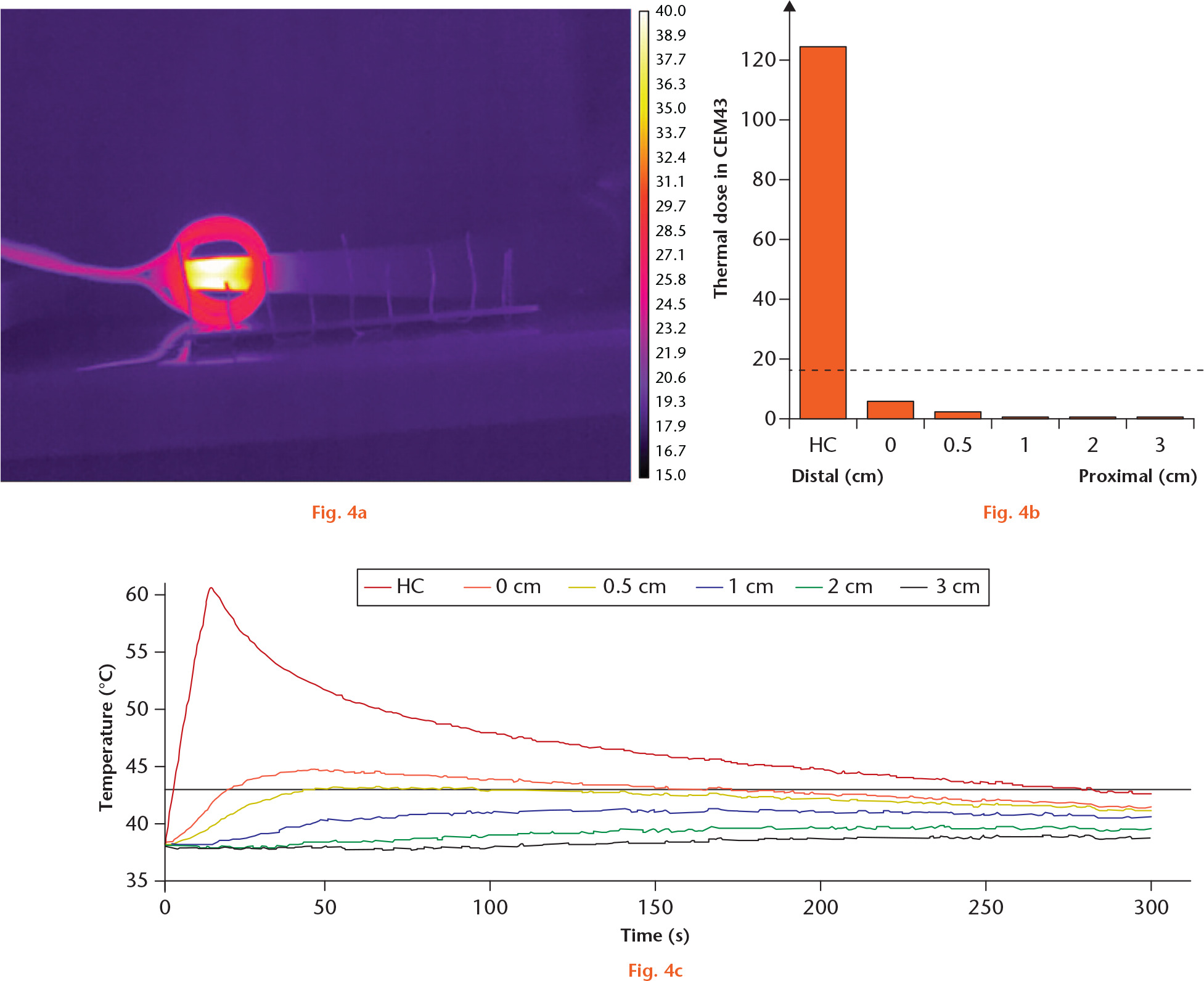  
            Segmental induction heating of hip stem, distally. a) A thermal image from a thermal camera showing selective heating. The vertical lines have 1 cm spacing. b) A graph showing thermal dose in CEM43 at several distances from the heating centre (HC). The dashed line represents 16 CEM43, the threshold for necrosis of bone. c) A graph showing the temperature at several distances from the HC during the segmental induction heating and thereafter.
          