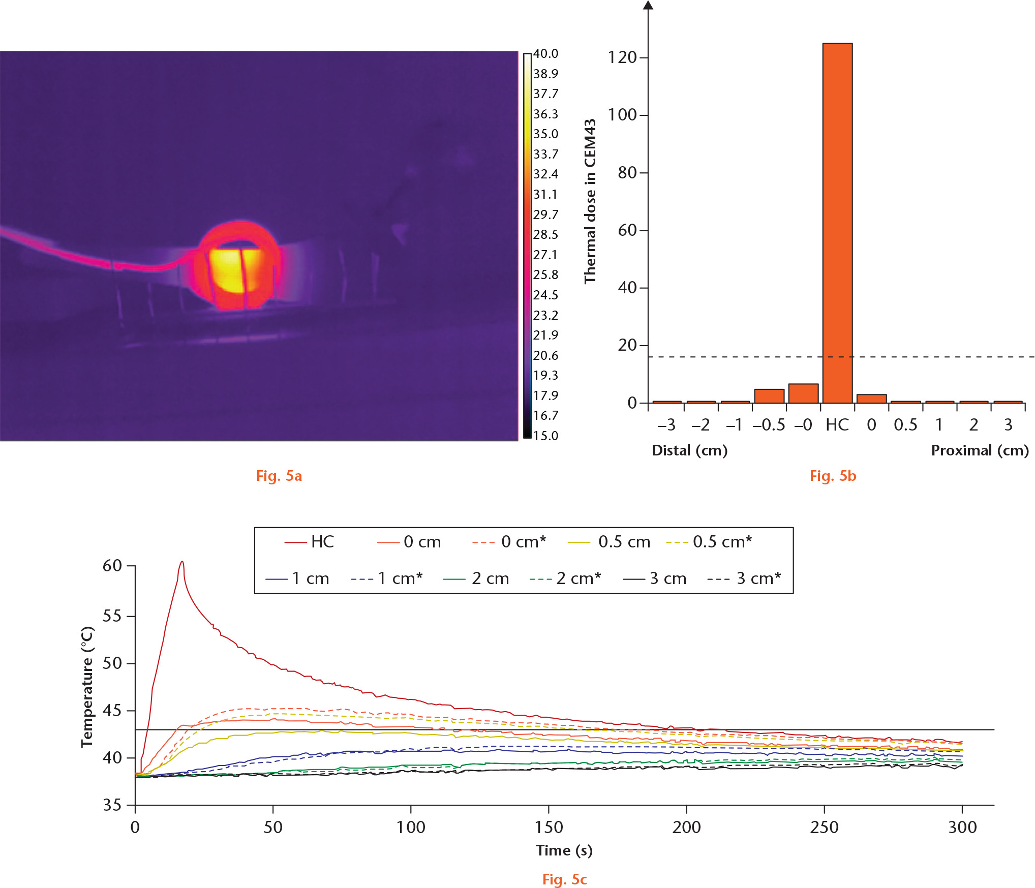  
            Segmental induction heating of hip stem centre. a) A thermal image from a thermal camera showing selective heating. The vertical lines have 1 cm spacing. b) A graph showing thermal dose in CEM43 at several distances from the heating centre (HC). The dashed line represents 16 CEM43, the threshold for necrosis of bone. c) A graph showing the temperature at several distances from the HC during the segmental induction heating and thereafter. Dashed lines indicate distal direction.
          