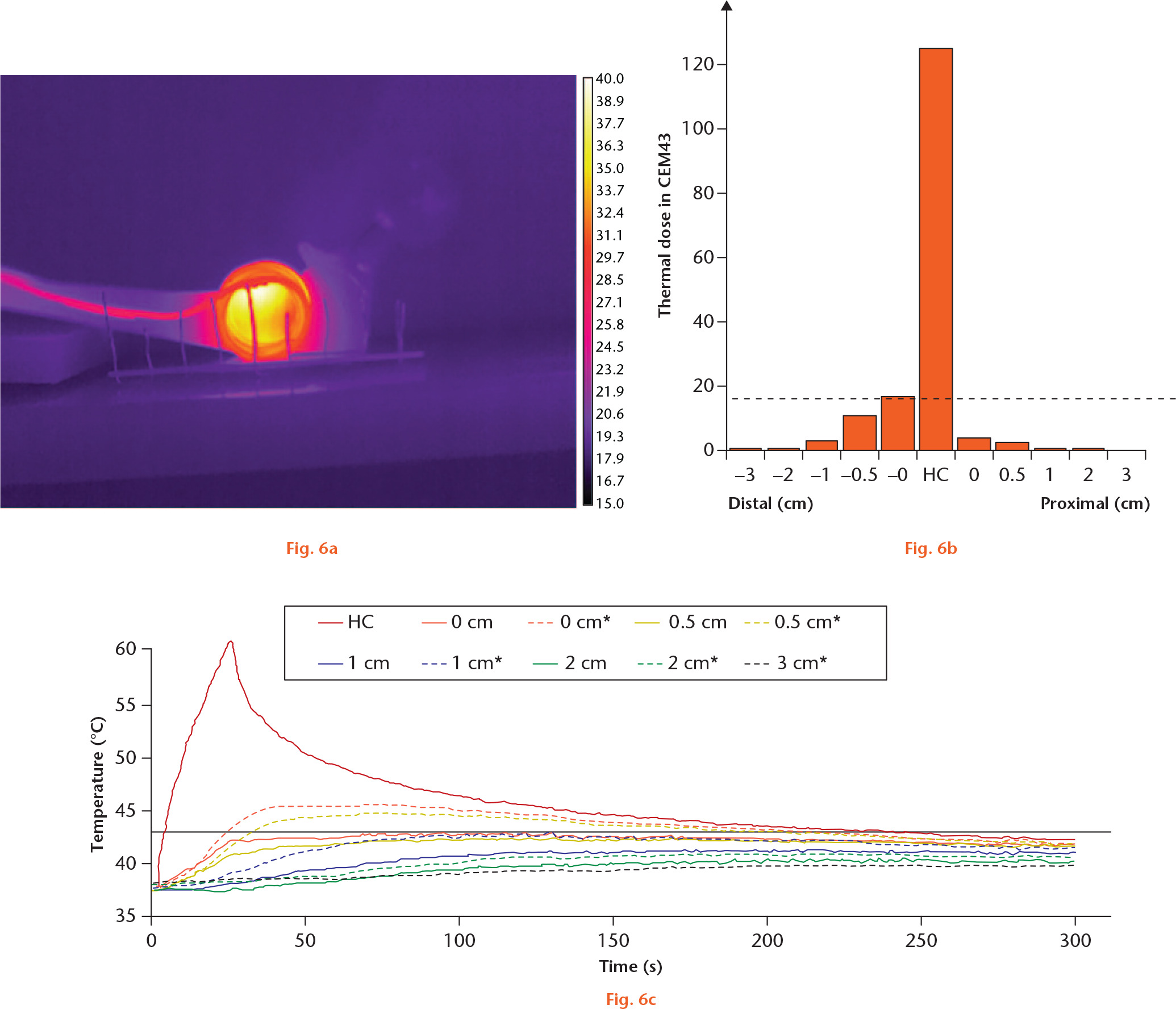  
            Segmental induction heating of hip stem, proximally. a) A thermal image from a thermal camera showing selective heating. The vertical lines have 1 cm spacing. b) A graph showing thermal dose in CEM43 at several distances from the heating centre (HC). The dashed line represents 16 CEM43, the threshold for necrosis of bone. c) A graph showing the temperature at several distances from the HC during the segmental induction heating and thereafter. Dashed lines indicate distal direction.
          