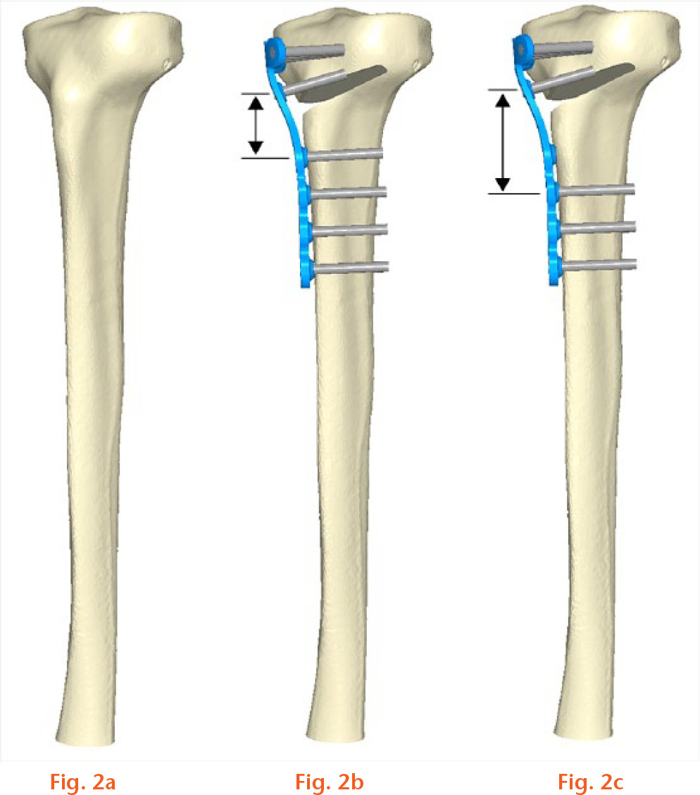  
          The different scenarios examined experimentally, showing: a) the intact tibia; b) the first screw configuration with a short bridging span annotated (plate superimposed for clarity); and c) the second screw configuration with a longer bridging span annotated.
        