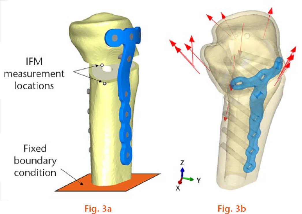  
            a) The measurement locations used to determine the interfragmentary movement (IFM) experimentally and in the finite element (FE) models; b) the locations of the applied muscle force vectors (not to scale).
          