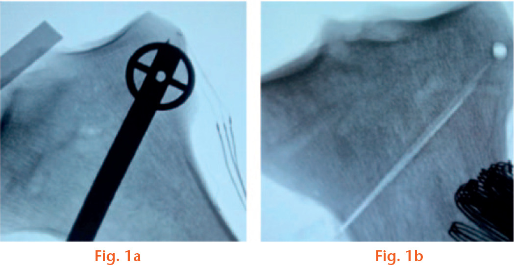 
            Fluoroscopic images of a) the resulting osteotomy cut and b) the pilot hole.
          