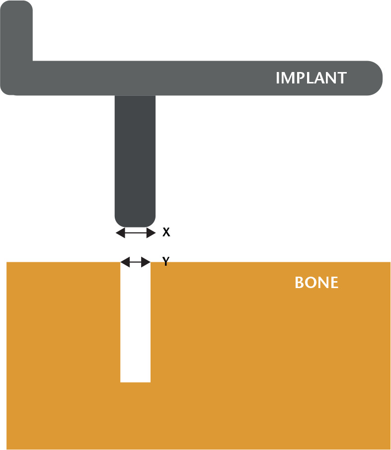 Fig. 1 
          The interference is calculated as the difference between the size of the implant (x) and the size of the bone cavity into which it is pressed (y) (interference = x–y).
        