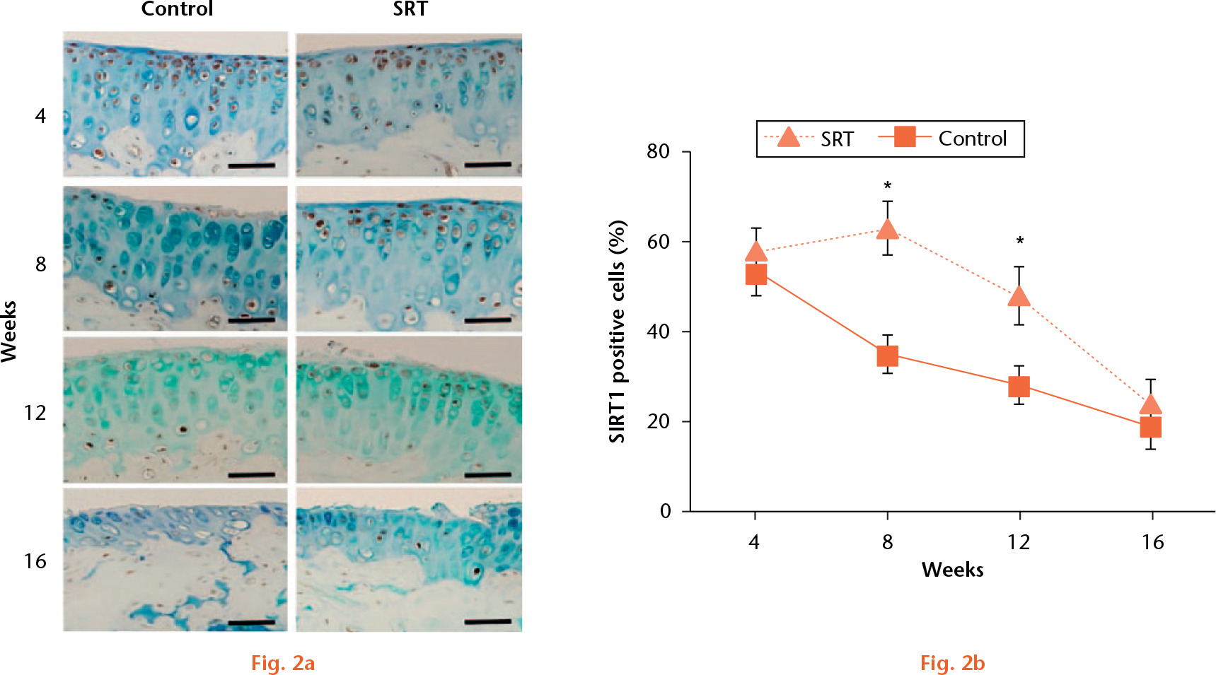  
            a) Immunohistochemistry of SIRT1 in the medial tibial plateau at four, eight, 12 and 16 weeks following surgery (scale bars = 50 μm); b) the percentage of SIRT1-positive cells. Three micrographs of the medial tibial plateau were taken under ×40 magniﬁcation. The percentage of SIRT1-positive chondrocytes was determined as (positive cells/total number of cells) × 100 (n = 5 male mice for each timepoint / group; *p < 0.05).
          