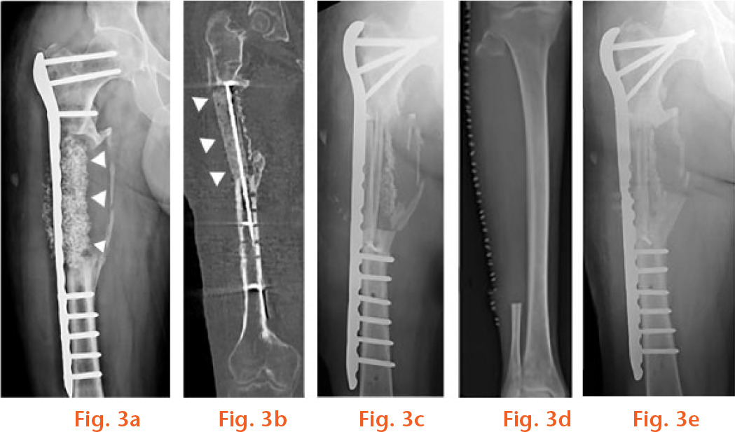  
          Radiological follow-up of a 44-year-old male patient with infected pseudarthrosis of the right femoral diaphysis and large bone defect after shotgun injury: a) anteroposterior radiograph of the right femur after plate stabilization and implantation of a calcium phosphate bone substitute (indicated by arrowheads) into the defect area without signs of integration or remodelling; b) CT scan after debridement of the defect and removal of most of the calcium phosphate, and implantation of an antibiotic-loaded bone cement spacer (indicated by arrowheads) augmented by a metal nail for local antimicrobial therapy; c) anteroposterior radiograph after removal of the spacer and implantation of a vascularized fibular graft (the fibula was harvested from the ipsilateral leg and fixed with screws into the defect in two parts nurtured by the same artery); d) anteroposterior radiograph from the ipsilateral lower leg demonstrates the donor site morbidity after removal of the fibula; e) anteroposterior radiograph after one-year follow-up. The fibular graft shows good integration and the implant is without loosening or failure.
        