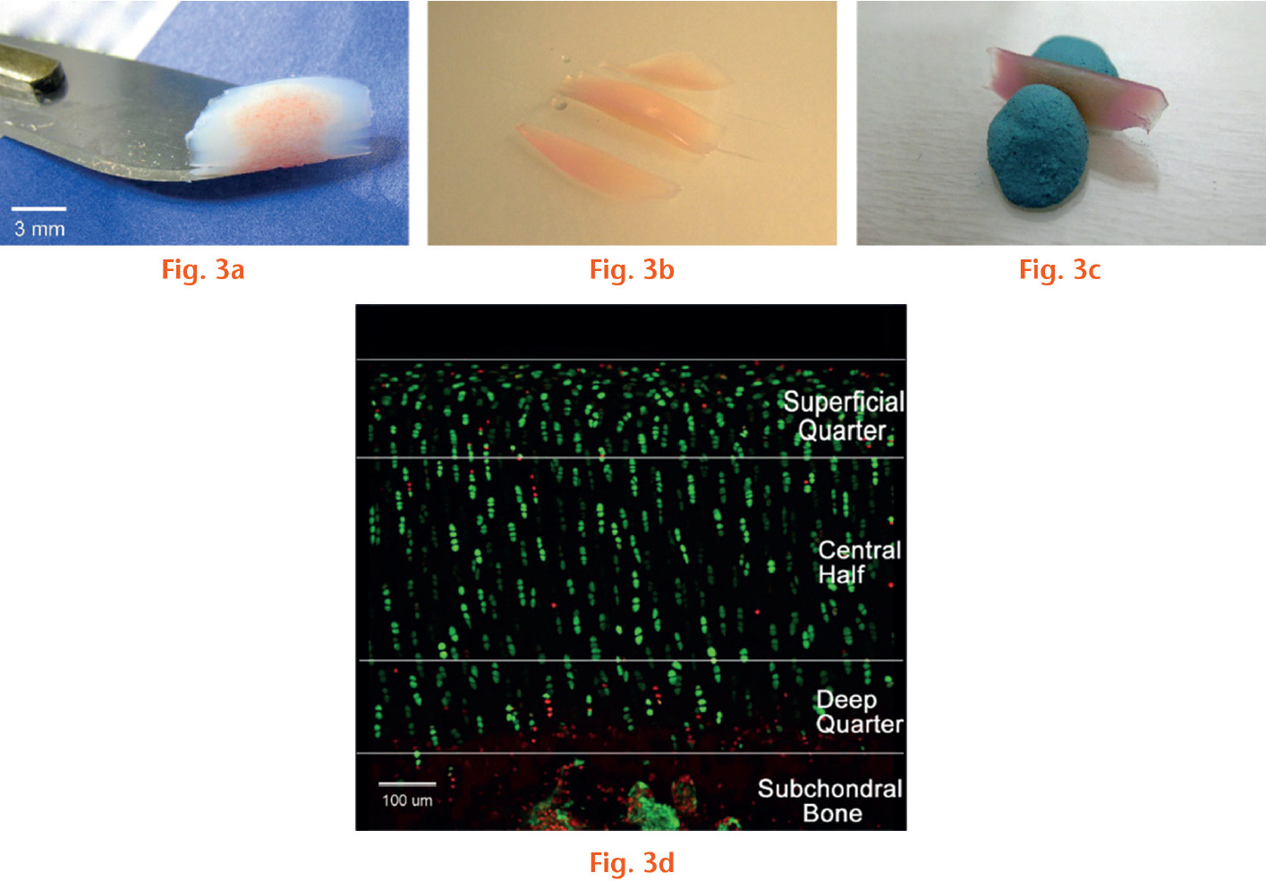  
            Images showing cartilage explant preparation and visualization of fluorescently-labelled in situ chondrocytes by confocal laser scanning microscopy: a) Explants, which included a small amount of subchondral bone attached in the centre, were taken to confirm that these were full-thickness osteochondral samples; b) the sample was cut into three pieces in which the two cut lines were parallel; c) the middle part was chosen and secured on a Petri dish with two small pieces of Blu Tack (Bostik, Leicester, United Kingdom). d) A coronal image illustrated the zonal distribution and viability of chondrocytes throughout the full cartilage thickness. Living chondrocytes were stained green by 5-chloromethylfluorescein diacetate (CMFDA) and dead chondrocytes stained red by propidium iodide (PI). The region of interest in the image was set according to the cartilage thickness. The top 25% thickness of cartilage was considered the superficial quarter, the subsequent 50% the central half, and the final 25% the deep quarter. At the bottom of the image, the subchondral bone contained multinucleated osteoblasts and osteoclasts.
          
