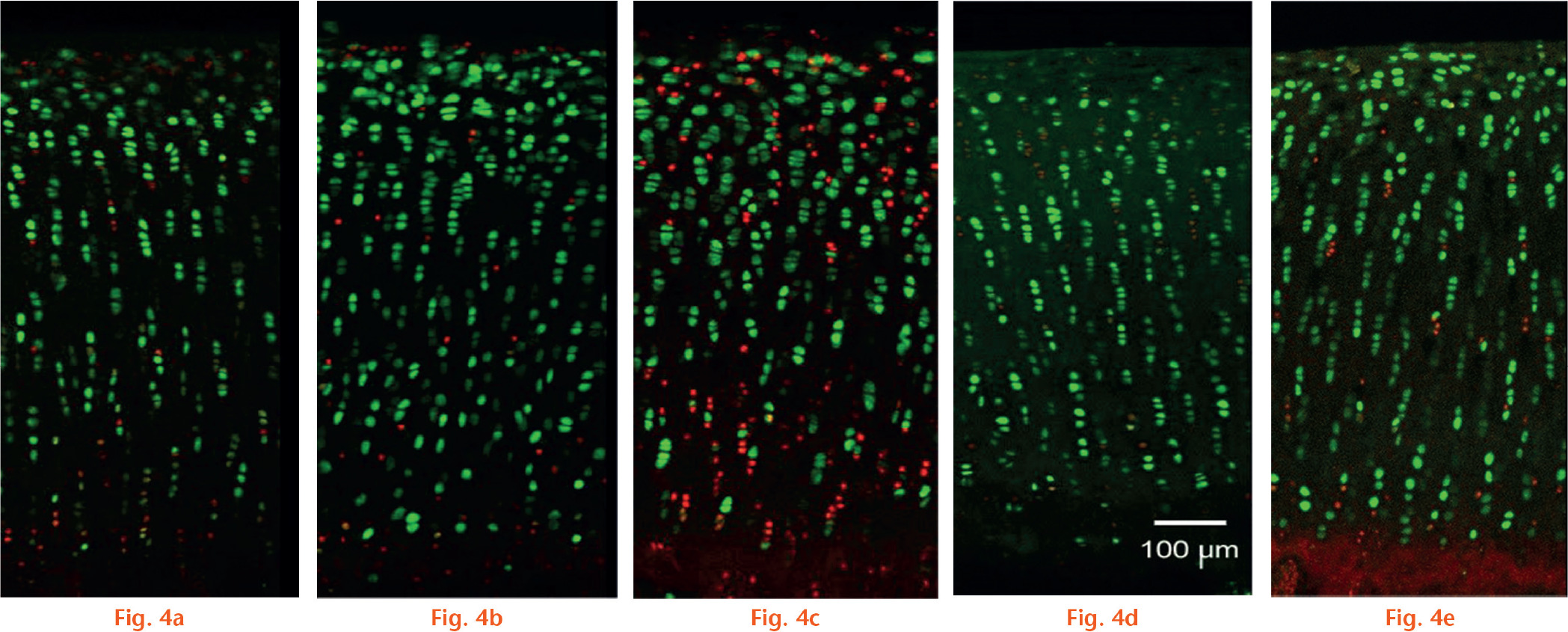  
            Image showing chondrocyte viability over time in the static and dynamic models. Under the confocal laser scanning microscope, images of the cartilage coronal section showed that the total cell population labelled with propidium iodide (PI) (in red) increased gradually from day 0 to day 28 in the static model (a to c), and most of the red cells were located in the superficial and deep quarter of the cartilage. In the dynamic model (d and e), only a few sporadically distributed PI-labelled chondrocytes were observed on day 28, and there were still live cells (in green) adjacent to the subchondral bone (a) day 0 control; b) day 14 static; c) day 28 static; d) day 14 dynamic; e) day 28 dynamic).
          