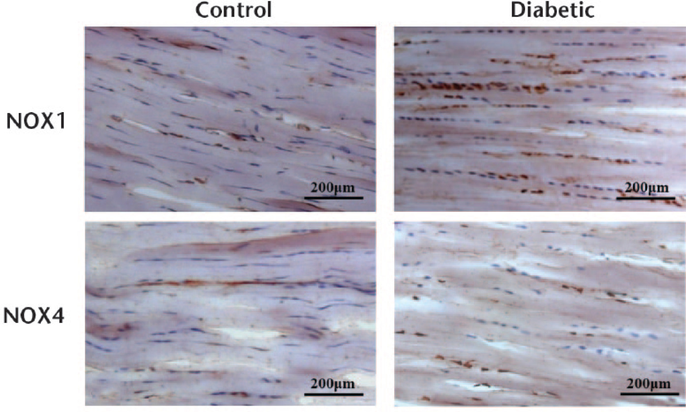 Fig. 6 
            Immunohistochemical staining for NADPH oxidase (NOX)1 and NOX4 expression in the Achilles tendon. The brown-stained cells were NOX-positive. Increased expression of NOX1 in Achilles tendon was observed in diabetic rats compared with control rats. There was no difference in the expression of NOX4 between diabetic and control rats.
          