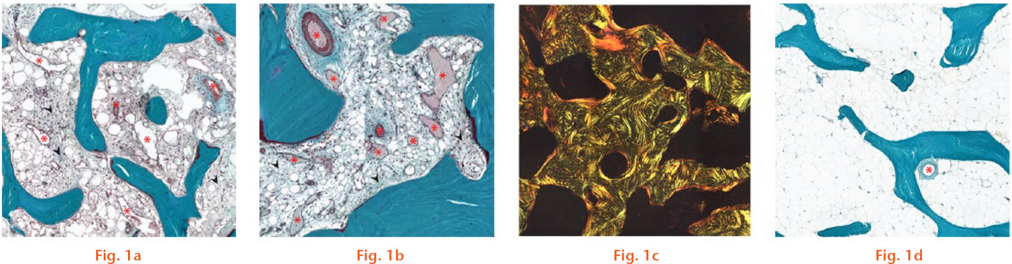  
            Representative histological images of subchondral bone (a, b and c) with and (d) without bone marrow lesions. Image of a section from (a) trapezium bone and (b) femoral head, demonstrating increased vascularity (asterisks) and marrow fibrosis (arrowheads). (d) Trapezium specimen imaged under polarized light showing disproportionately large area of woven bone compared with area covered by lamellar bone.
          