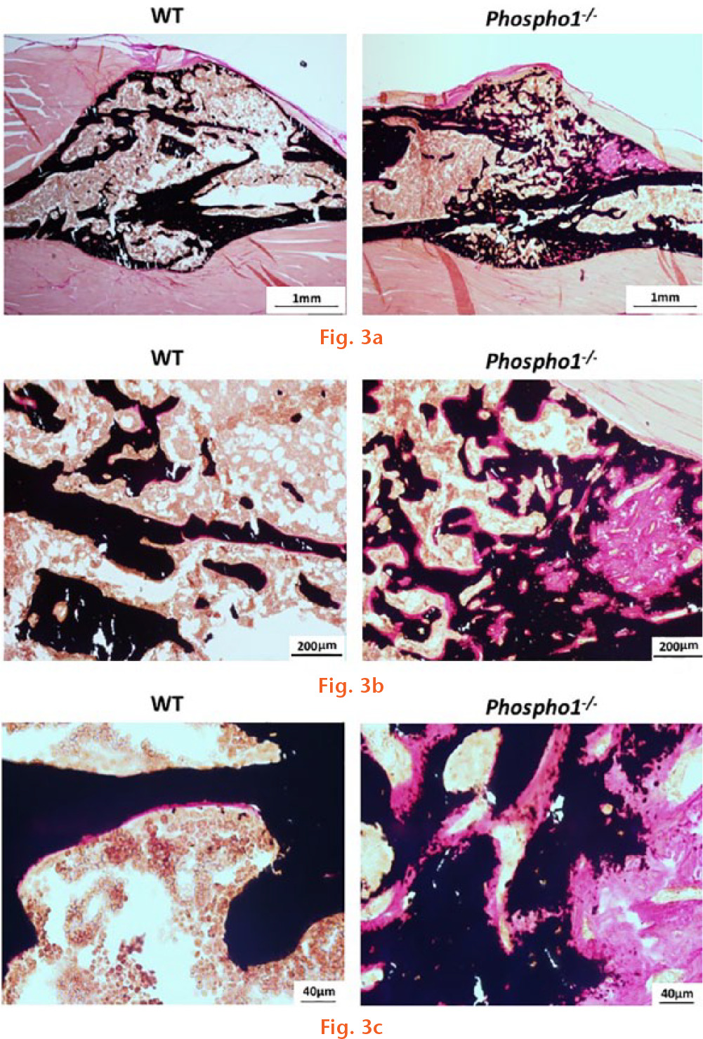 Fig. 3c 
            Microscopic images of tibia sections showing the fracture site. The sections were stained as per von Kossa and van Gieson, which stains unmineralized bone pink and mineralized bone black: a) wild-type (WT) sections showing normal fracture healing with a minimal amount of trabecular bone and evenly distributed osteoid. On the other hand, the Phospho1-/- fracture sections showed increased trabecular number and the osteoid formation. Panels (b) and (c) show the magnified view of the fractured bone sections.
          