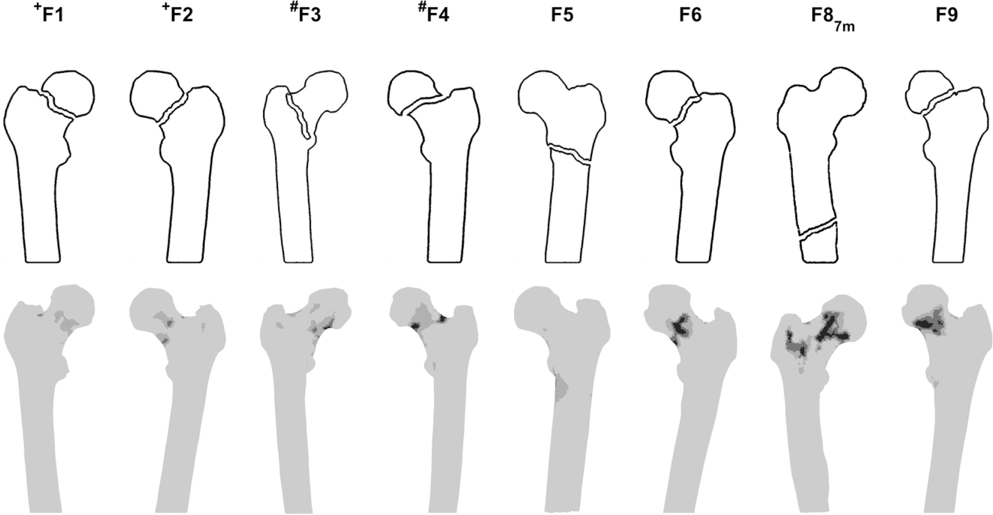 Fig. 3 
            Schematic overview of clinical fracture locations (upper panel), indicated by an experienced clinician who was blind to the predicted fracture locations, and the fracture locations at failure (mid-coronal plane) predicted by the finite element models (lower panel). Femurs indicated with + and # are paired femurs. F8 fractured one month after follow-up (7m). There was no clinical information about fracture location available for F7.
          