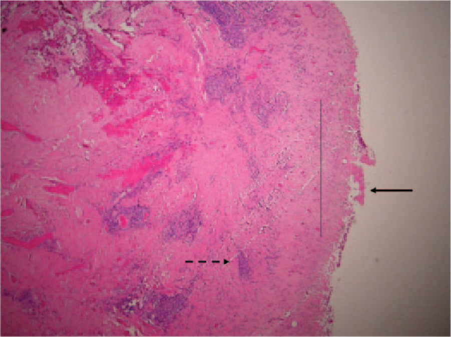 Fig. 1 
            Histology showing grade 1 (mild) aseptic lymphocyte-dominated vasculitis-associated lesion (ALVAL). There is fibrin deposition on the surface membrane with minimal necrosis (unbroken arrow). Macrophages are present, with visible metal debris (thin, unbroken line). There are thin perivascular lymphocytic cuffs forming aggregates but not follicles (broken arrow).
          