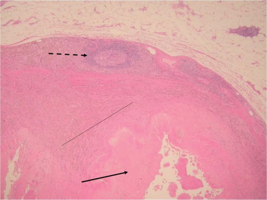 Fig. 2 
            Histology showing grade 2 (moderate) aseptic lymphocyte-dominated vasculitis-associated lesion. There is fibrin deposition as well as necrosis of the surface membrane (unbroken arrow). Sheets of macrophages containing metal debris are visible (thin, unbroken line). Lymphoid aggregates are present but there is no follicle formation (broken arrow).
          