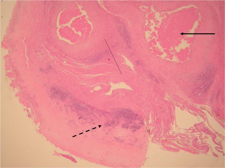 Fig. 3 
            Histology showing grade 3 (severe) aseptic lymphocyte-dominated vasculitis-associated lesion. There are coalescing perivascular lymphocytic aggregates and development of lymphoid follicles (broken arrow). There is extensive surface necrosis (unbroken arrow) and sheets of macrophages containing metal debris (thin, unbroken line).
          