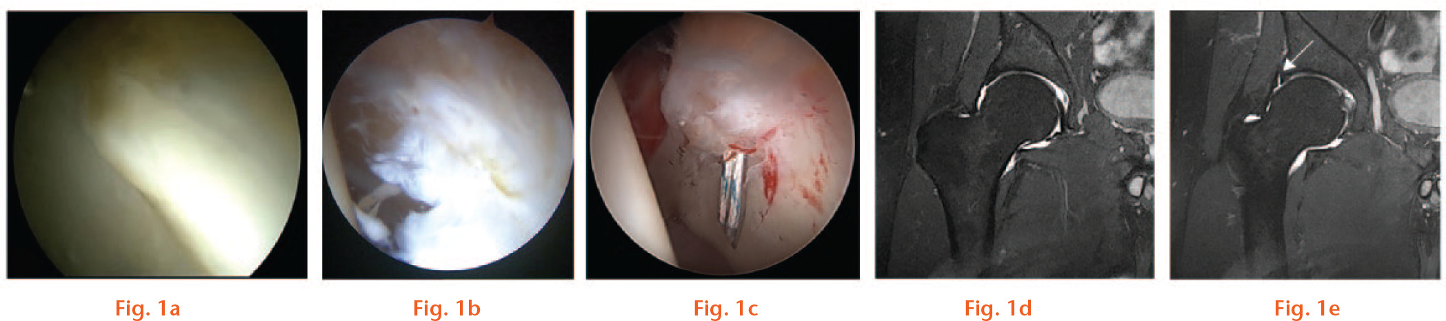 
          Intraoperative and radiological imaging of the acetabular labrum. a) An intact and b) a torn human labrum viewed through an arthroscope; c) a torn labrum undergoing arthroscopic repair; coronal T2 MRI images of a human hip with d) an intact and e) a torn labrum (tear highlighted with an arrow).
        