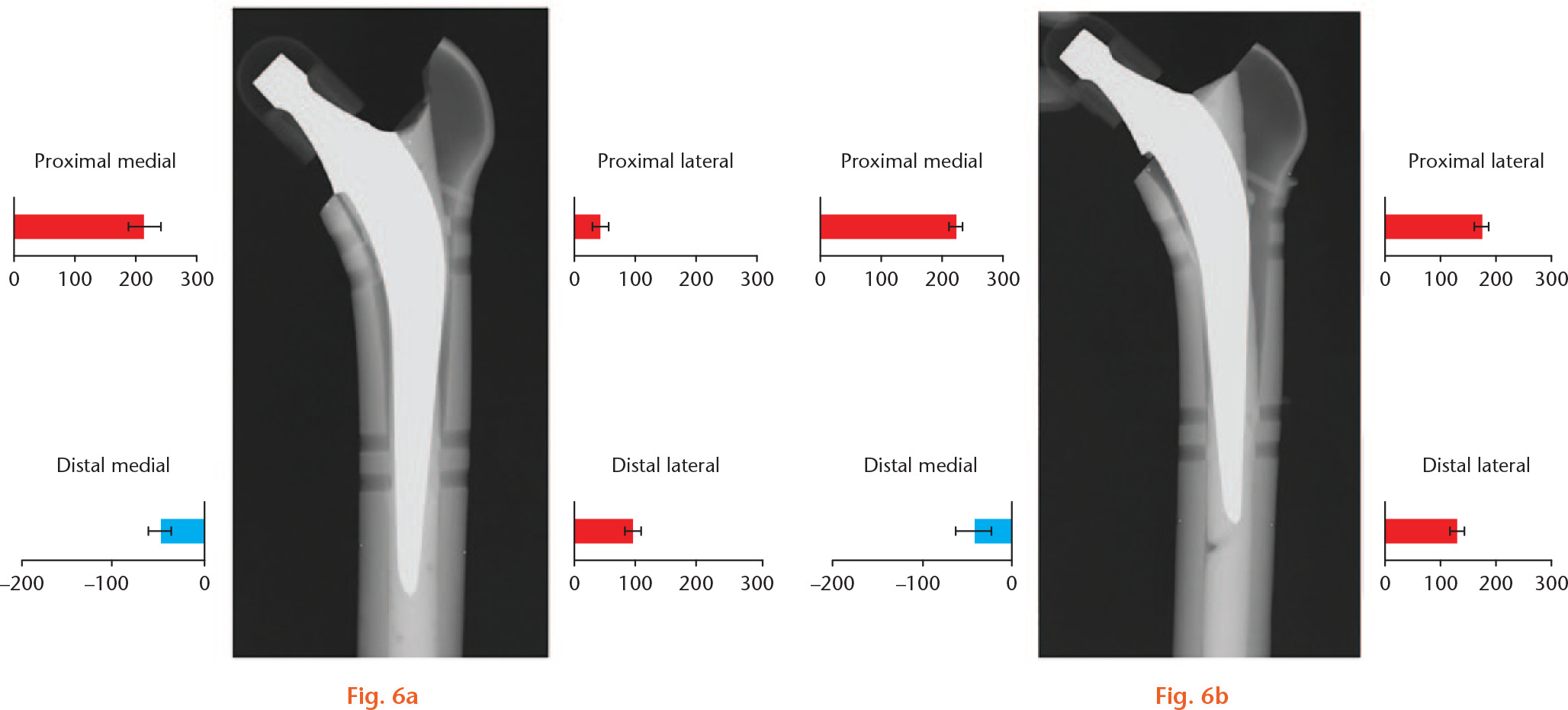  
            The final compressive forces at the cement-bone interface for a) the contact group and b) the non-contact group. Major three regions of great compressive force were seen in proximal medial and lateral regions and distal lateral region. Negative small compressive force was seen in distal medial region. The value of bar was mean force in each group, and standard deviation was expressed as a line.
          