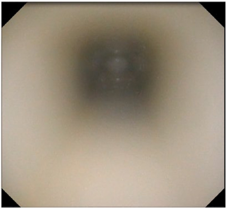 Fig. 8 
            A fiberscope finding. No cement breakage was noted in any of the models when observed through a fiberscope, even though the cement mantle was relatively thin.
          