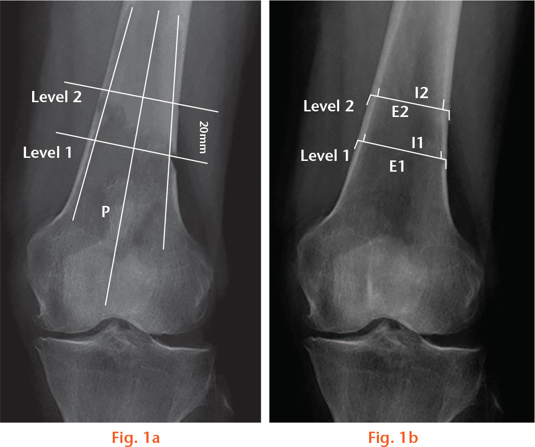  
            Schematic diagrams of the radiographic parameters on the anteroposterior view of the knee joint: a) the location of the two levels; b) the width of the entire bone and intramedullary canal; the cortical thickness of the medial and lateral side of the distal femur at these levels.
          