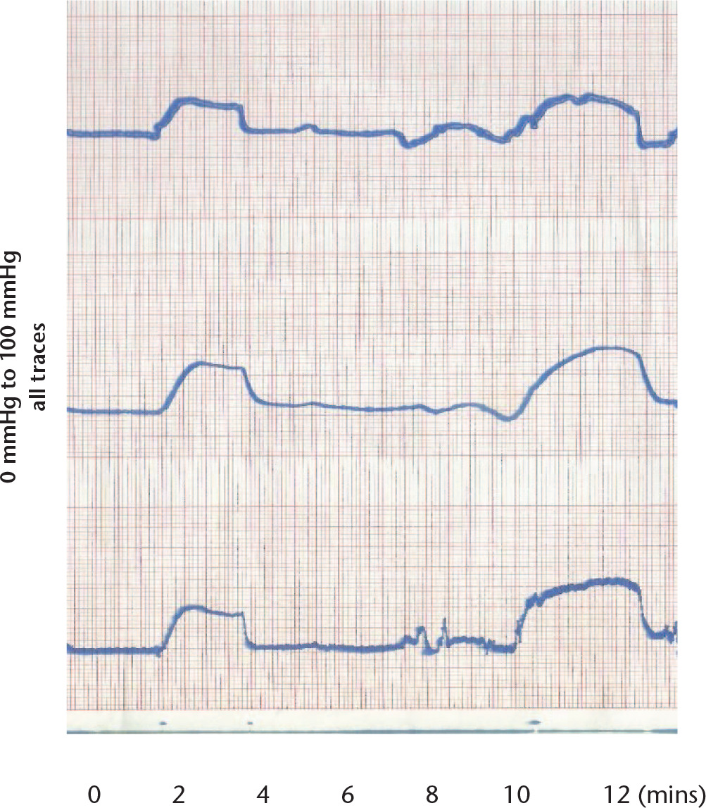 Fig. 3 
            Graph showing the effect of loading alone with one body weight. Upper trace - femoral head, middle trace - femoral condyle and lower trace - proximal tibia. All traces shows basal intraosseous pressure, loading by one body weight for two minutes, rest for six minutes and load for three minutes. Vertical scale 0 mmHg to 100 mmHg on all traces, trace speed 12.5 mm/min.
          