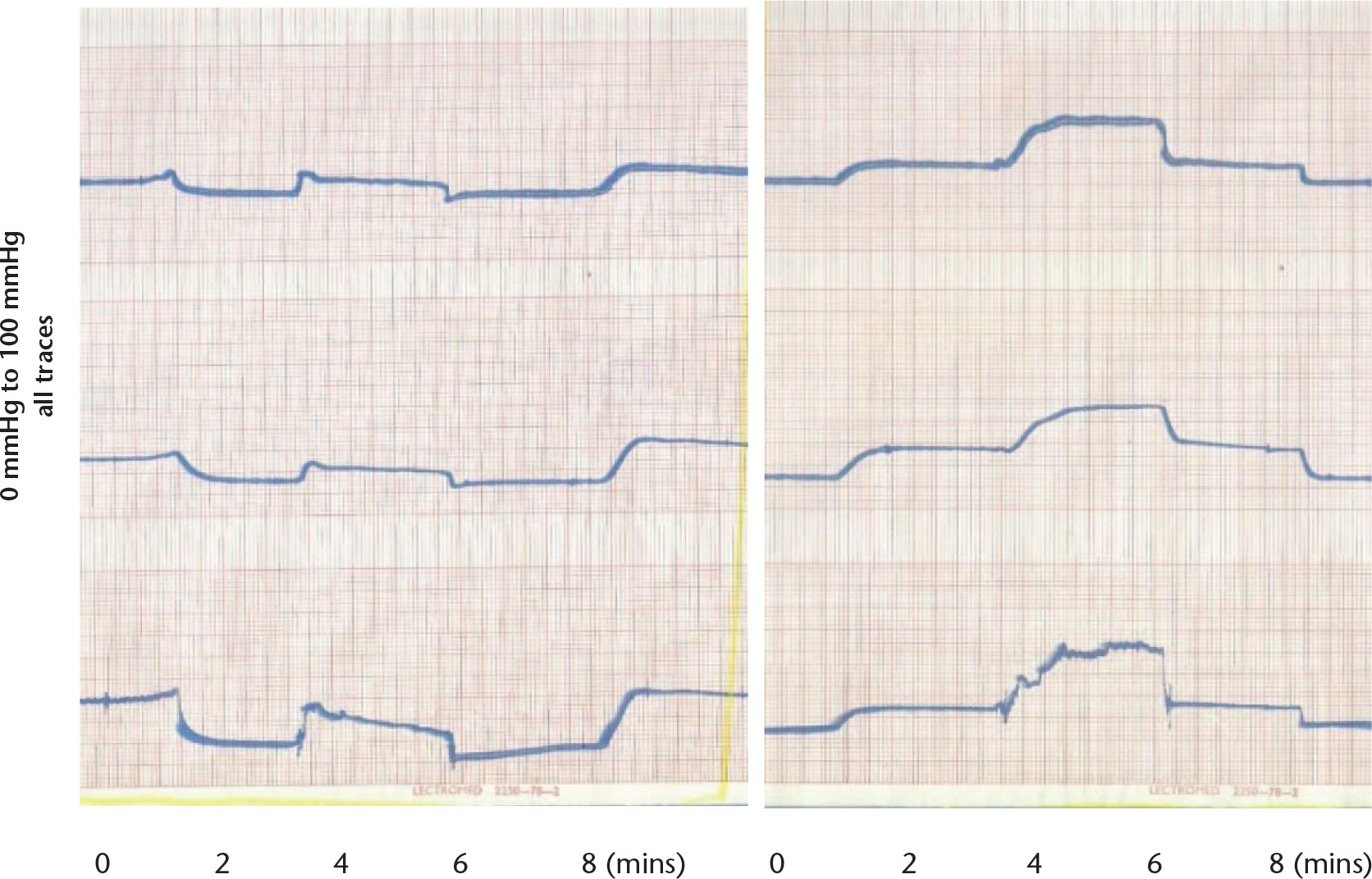 Fig. 4 
            Graphs showing the upper trace from the femoral head, middle trace femoral condyle and lower trace proximal tibia. From left to right, the traces show the effect of arterial occlusion, arterial occlusion with loading, load removal and arterial clamp removal. The second part shows changes at the same sites after venous occlusion, venous occlusion with loading, removal of load and removal of the occluding clamp. The intraosseous pressure changes are seen to be similar at all three sites and simultaneous. Vertical scale 0 mmHg to 100 mmHg on all traces, trace speed 12.5 mm/min.
          
