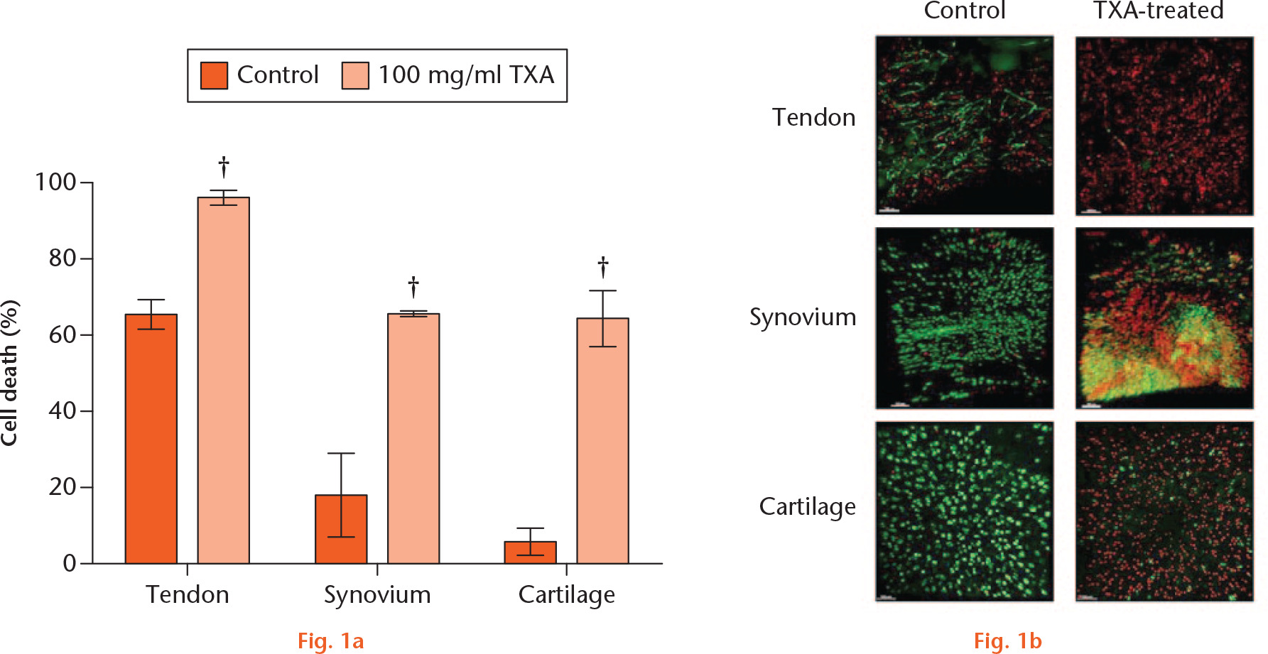  
            Tranexamic acid (TXA) toxicity in periarticular tissues ex vivo. a) Percentage of dead cells in control (0 mg/ml) and TXA-treated (100 mg/ml) cells in each periarticular tissue (n = 3 tendon, synovium; n = 4 cartilage) after 16 hours of treatment. Mean ± standard error of the mean; Student’s paired t-test. †p < 0.01. b) Tendon, synovium, ligament, and cartilage tissue imaged by confocal microscopy with 5-chloromethylfluorescein diacetate (CMFDA) and propidium iodide (PI) stain at 16 hours of treatment in control and TXA-treated (100 mg/ml TXA cells). Green stained cells counted as live and red stained cells counted as dead.
          
