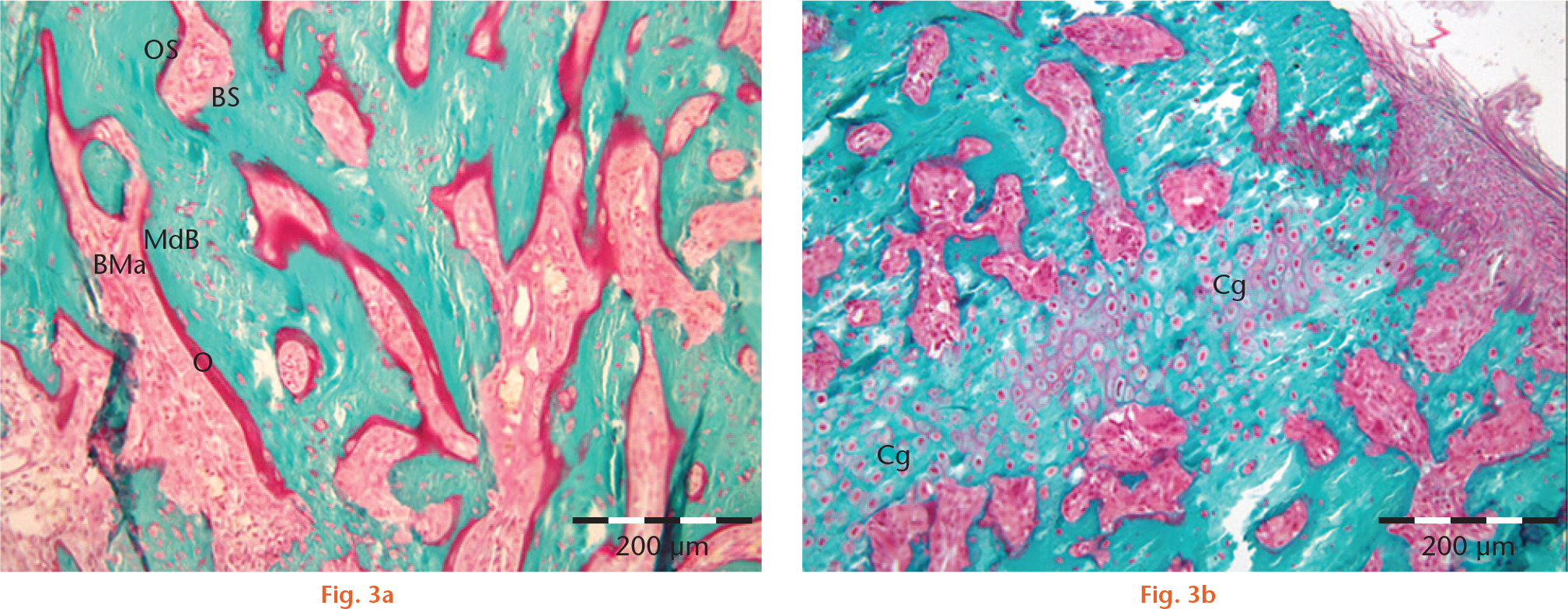 Fig. 3 
            High-power magnification light microscopy of tibial fracture calluses. Masson–Goldner trichrome staining of mineralized tissue provides good differentiation between osteoid (O, purple) and mineralized bone matrix (MdB, green). Non-mineralized bone marrow (BMa, red) is distributed between the mineralized bone trabeculae. a) Woven bone formation (control group) with mainly osteoid trabecular surfaces (OS) and a few bone surfaces (BS). b) An immature region within the callus-containing cartilage (Cg) and partly mineralized matrix with ongoing endochondral ossification. Scale bars = 200 μm.
          