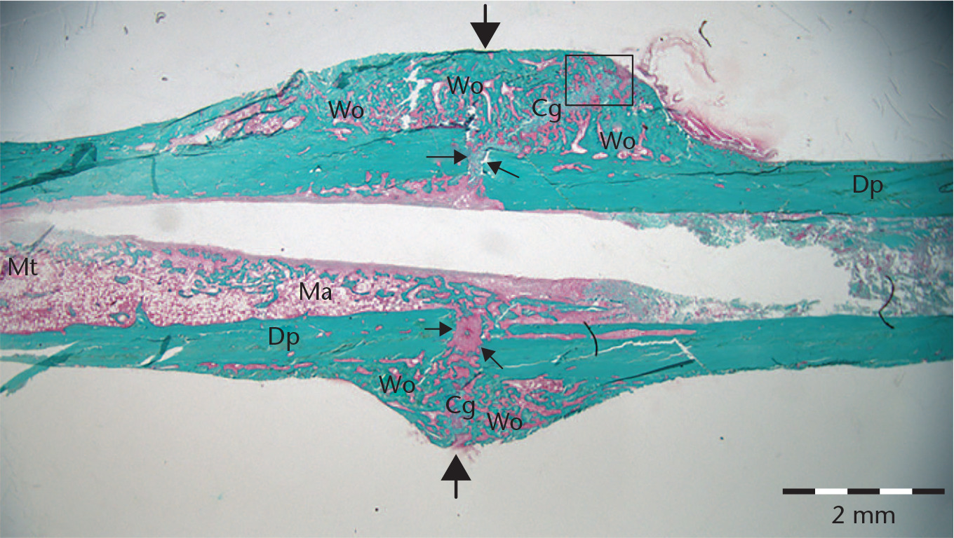 Fig. 5 
            Low-power magnification light microscopy of Masson–Goldner trichrome-stained coronal section of diaphyseal (Dp) tibial fracture (between large arrows) at four weeks (‘parecoxib immediate’ (Pi) group), showing bridging callus formation on both sides. Callus consists of woven bone (Wo) and immature cartilage (Cg). The metaphyseal (Mt) region in the section is localized proximally. Small arrows indicate the original cortical fracture gap. The medullary canal contains displaced bone marrow (Ma). The clear space represents the area of the extracted nail. The rectangle shows the area displayed at high magnification in Figure 3b. Scale bar = 2 mm.
          