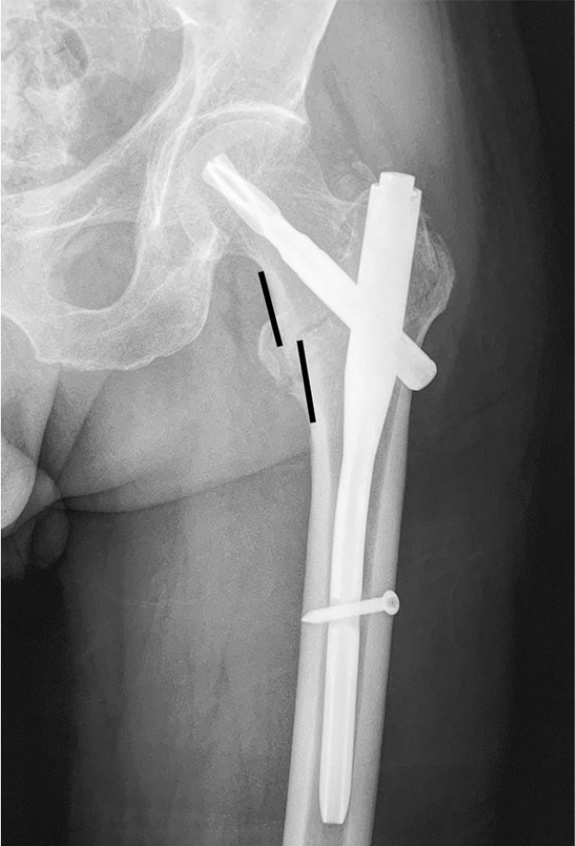 Fig. 1 
          Radiograph showing positive medial cortex support, which is defined as a situation where the lower edge of the medial cortex of the femoral head–neck fragment is located medially to the upper edge of the medial cortex of the femoral shaft, with the displacement less than one cortex thickness.
        