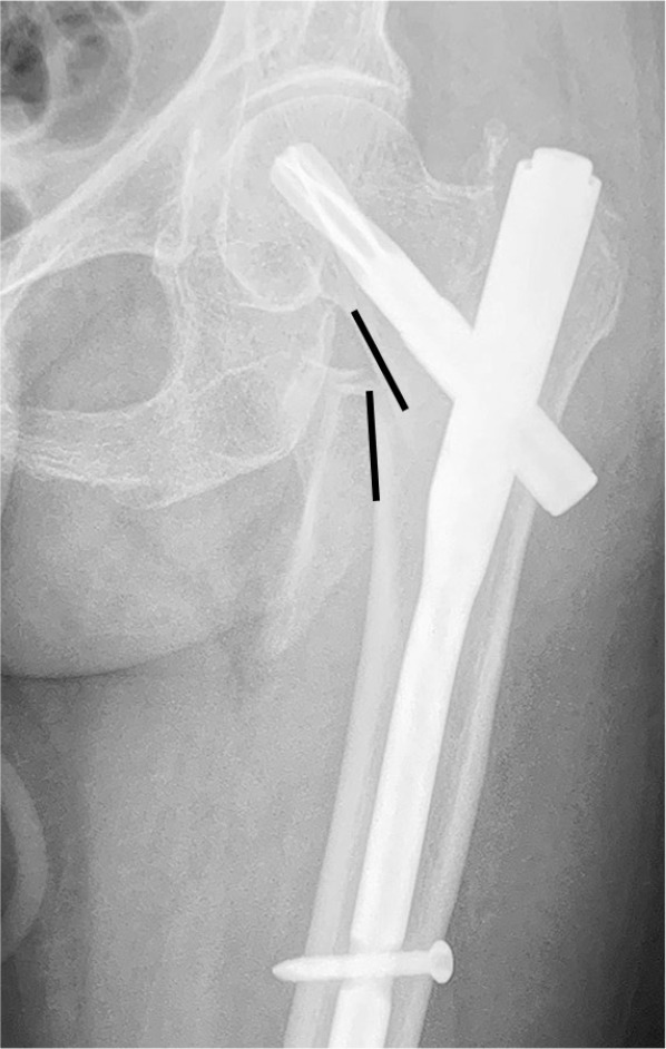 Fig. 2 
          Radiograph showing negative medial cortical support, which is defined as a situation where the lower edge of the medial cortex of the femoral head–neck fragment is located laterally to the upper edge of the medial cortex of the femoral shaft, regardless of the distance of displacement.
        