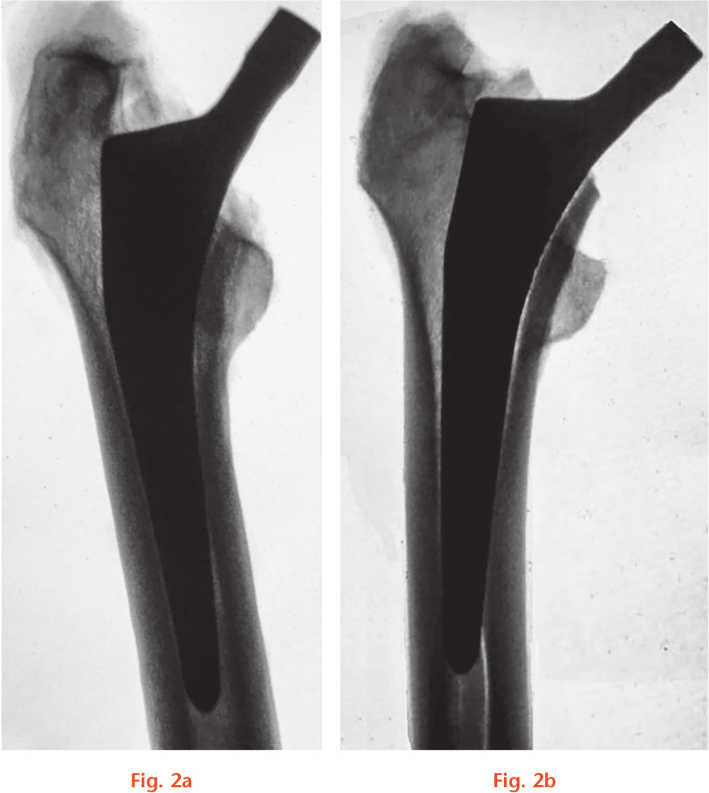 Fig. 2 
          a) Anteroposterior view of a specimen with an implanted type 2 stem; b) anteroposterior view of a fractured specimen with an implanted type 2 stem.
        