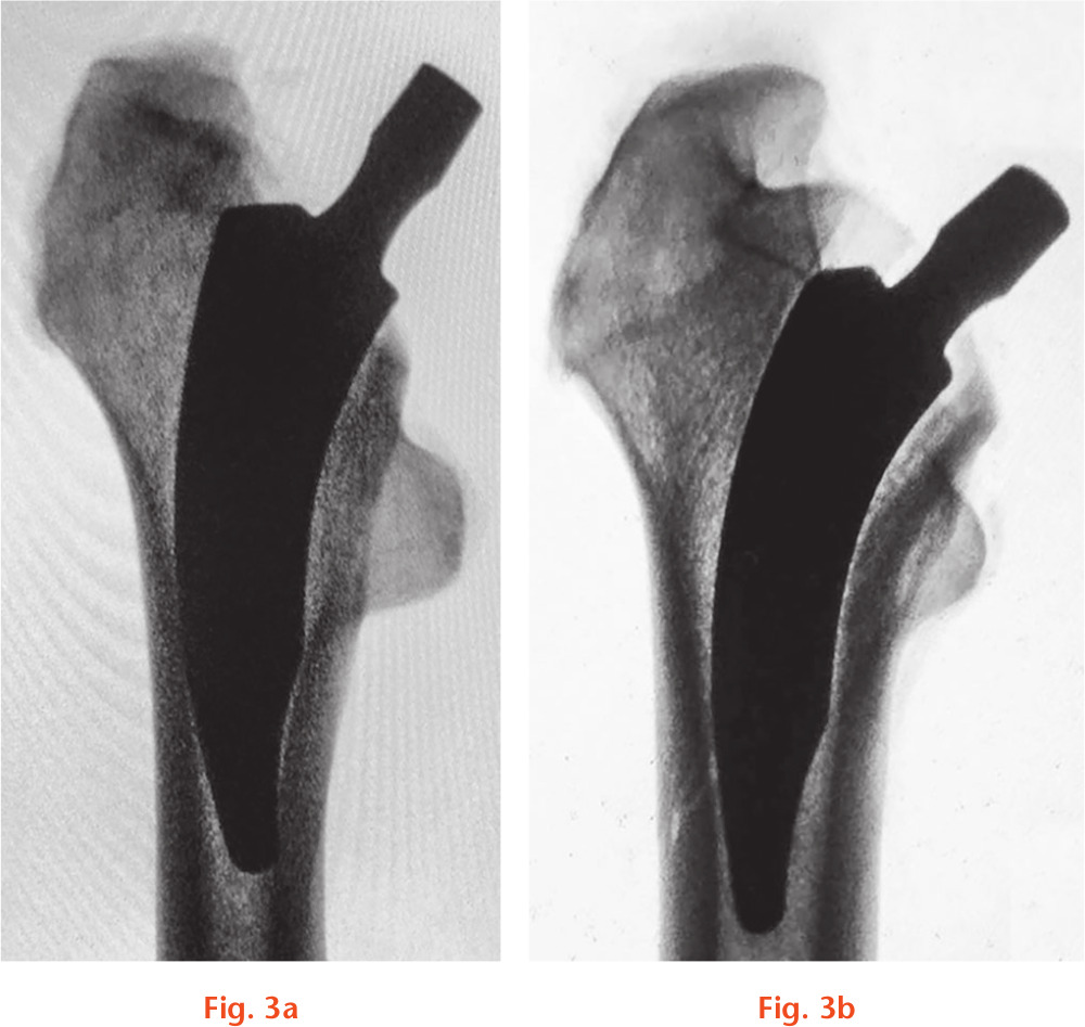 Fig. 3 
          a) Anteroposterior view of a specimen with an implanted type 6 stem; b) anteroposterior view of a fractured specimen with an implanted type 6 stem.
        