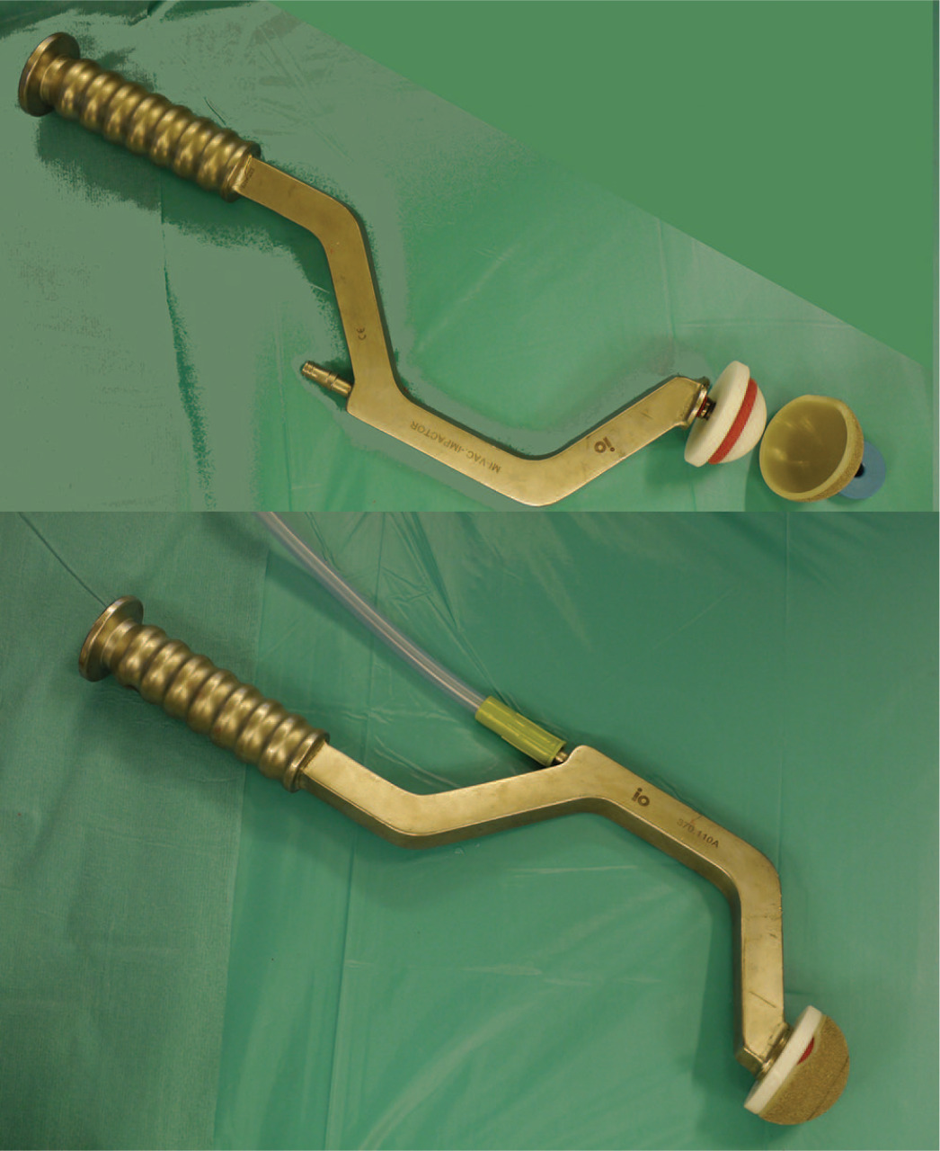 Fig. 2 
            Vacuum introducer to seat the component. The implant and introducer are coupled using 650 mm Hg negative pressure, through a size-specific implantation plate (supplied with the implant).
          