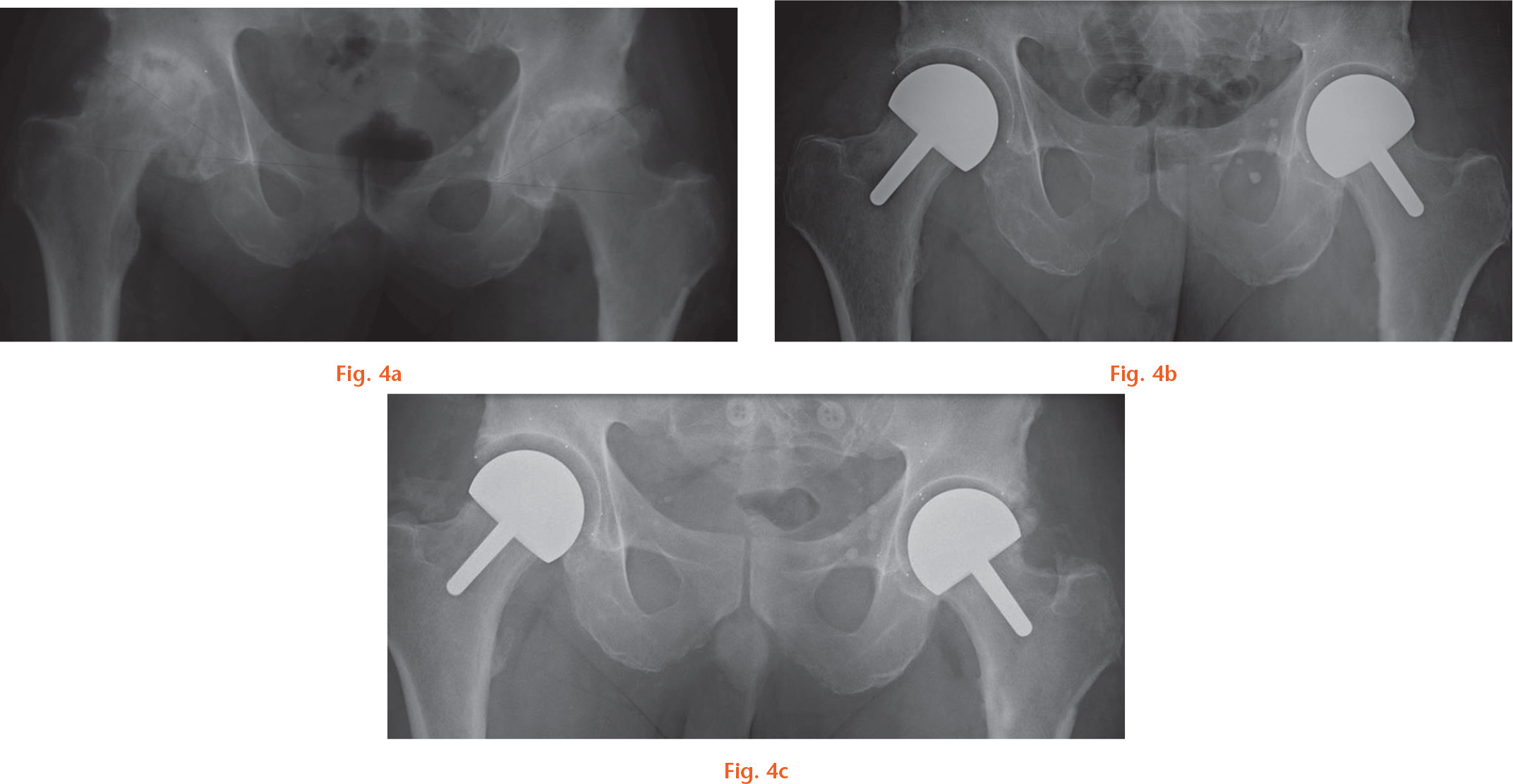 Fig. 4 
          Radiological series of a 59-year-old male surgeon with an active lifestyle, including rowing, spinning, and gymnastics: a) preoperatively; b) at two months; and c) at one year. He presented with bilateral painful arthritic hips. He refused metal-on-metal hip resurfacing arthroplasty and total hip arthroplasty, and specifically requested a metal-on-crosslinked-polyethylene. Superolateral erosion creating secondary dysplasia required the use of a 10 mm inner diameter–outer diameter difference component on the right side. The more commonly used 6 mm sufficed on the left. At one year, he had returned to previous activity. A radiograph at one year showed grade I heterotopic ossification.
        