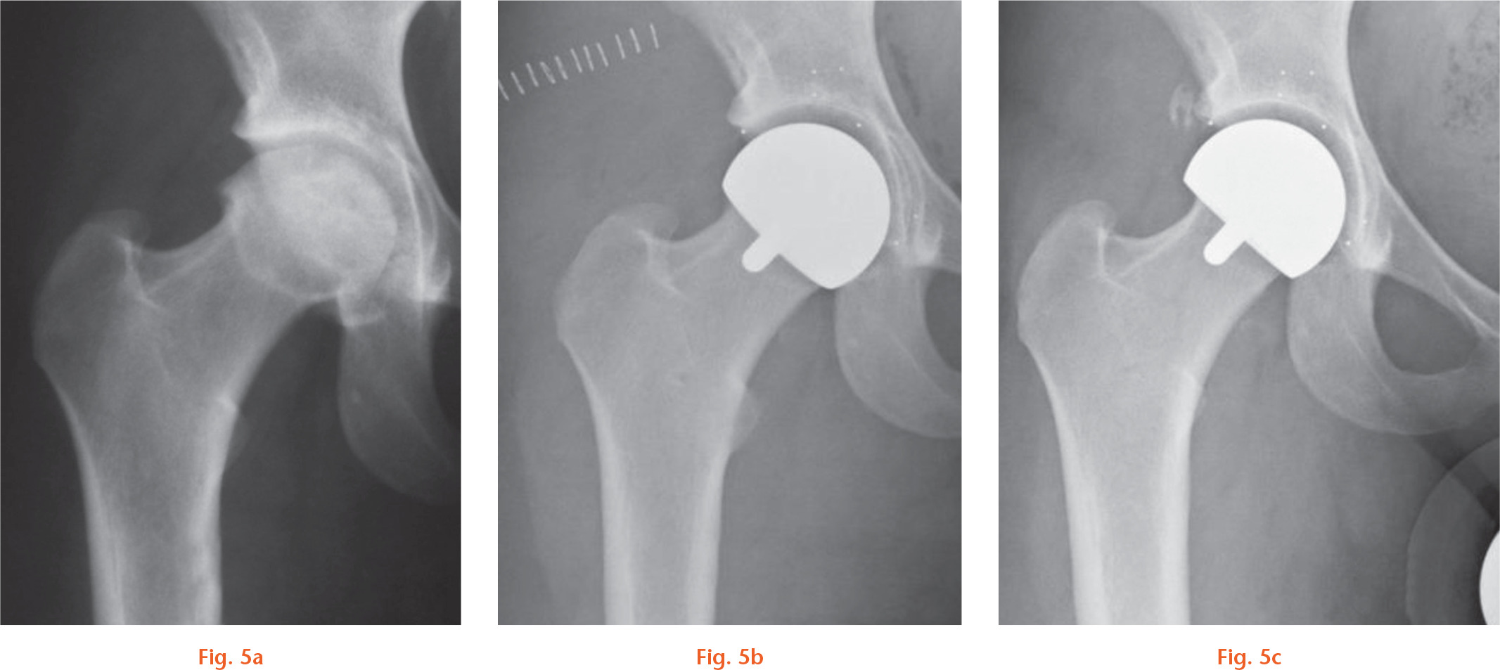 Fig. 5 
          Radiological series of a 21-year-old female university student: a) preoperatively; b) at two days; and c) at one year. She presented with post-Perthes’ disease bilateral painful hips, with her right hip being the most troublesome. Her presenting condition and young age made her an ideal candidate for a bone-conserving procedure. A custom crosslinked-polyethylene resurfacing was performed with 42 mm/48 mm components. At one year, she was back to sporting activity and has started a career.
        